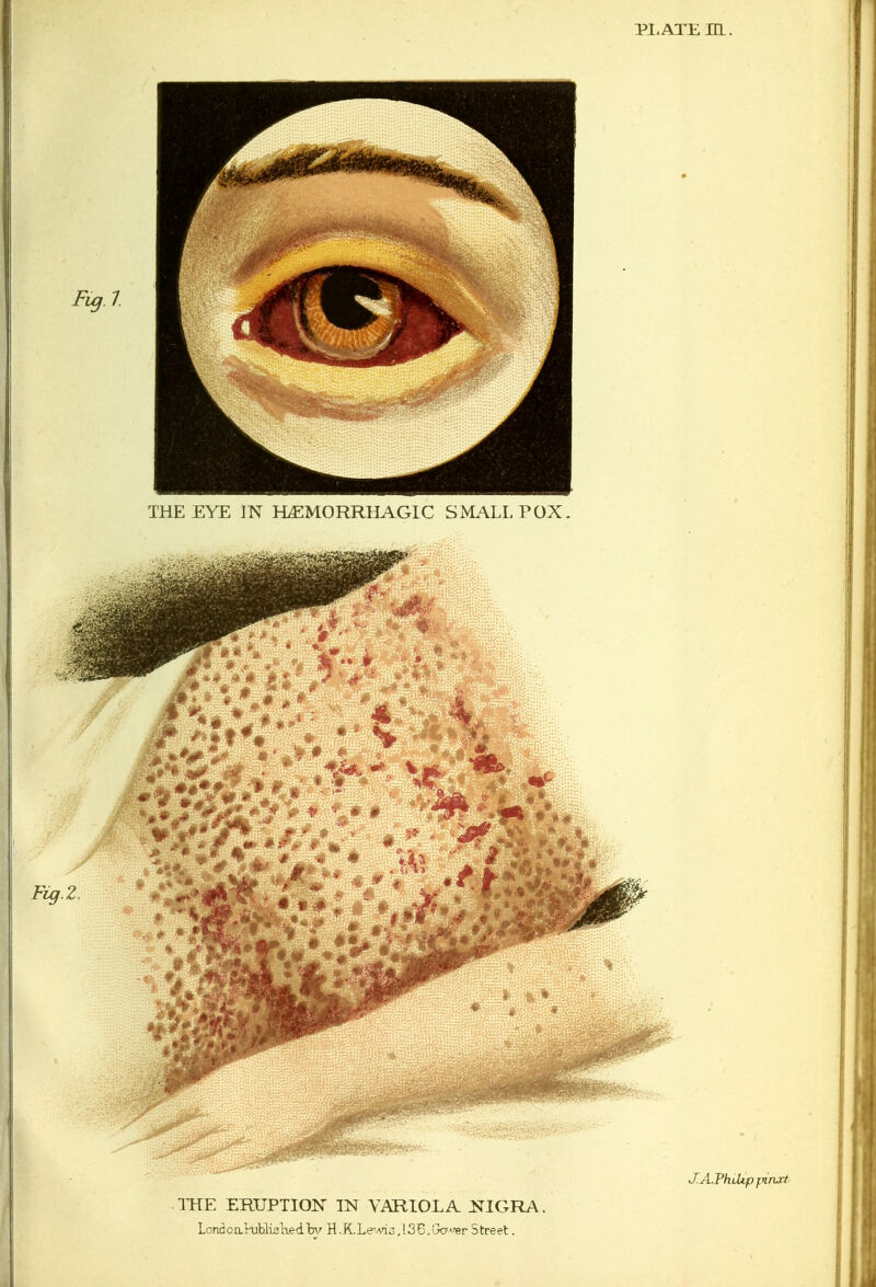 PLATE UL. Fig. I THE EYE IN HEMORRHAGIC SMALLPOX. THE ERUPTION IN VARIOLA NIGRA. Land oill^klisWdW H.KLewi3,I3i6.Gower 5treet. J.A.ThiHp pinat