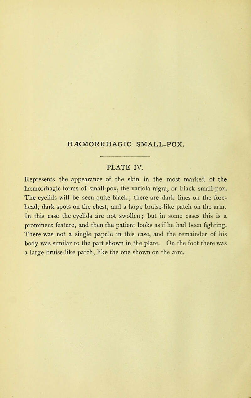 PLATE IV. Represents the appearance of the skin in the most marked of the hemorrhagic forms of small-pox, the variola nigra, or black small-pox. The eyelids will be seen quite black; there are dark lines on the fore- head, dark spots on the chest, and a large bruise-like patch on the arm. In this case the eyelids are not swollen; but in some cases this is a prominent feature, and then the patient looks as if he had been fighting. There was not a single papule in this case, and the remainder of his body was similar to the part shown in the plate. On the foot there was a large bruise-like patch, like the one shown on the arm.