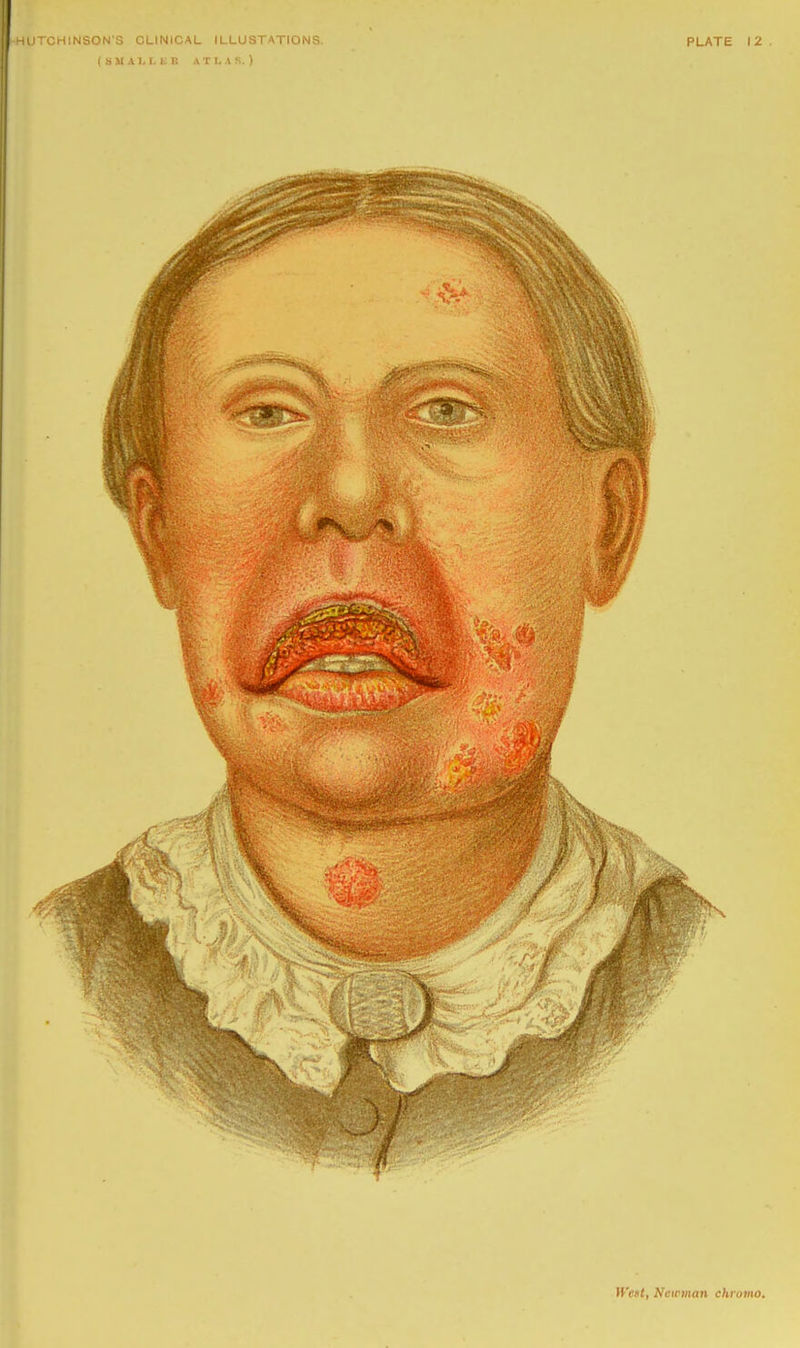 CHINSON'S CLINICAL ILLUSTATIONS. ( S U A ), I. K R ATLAS.) PLATE 12