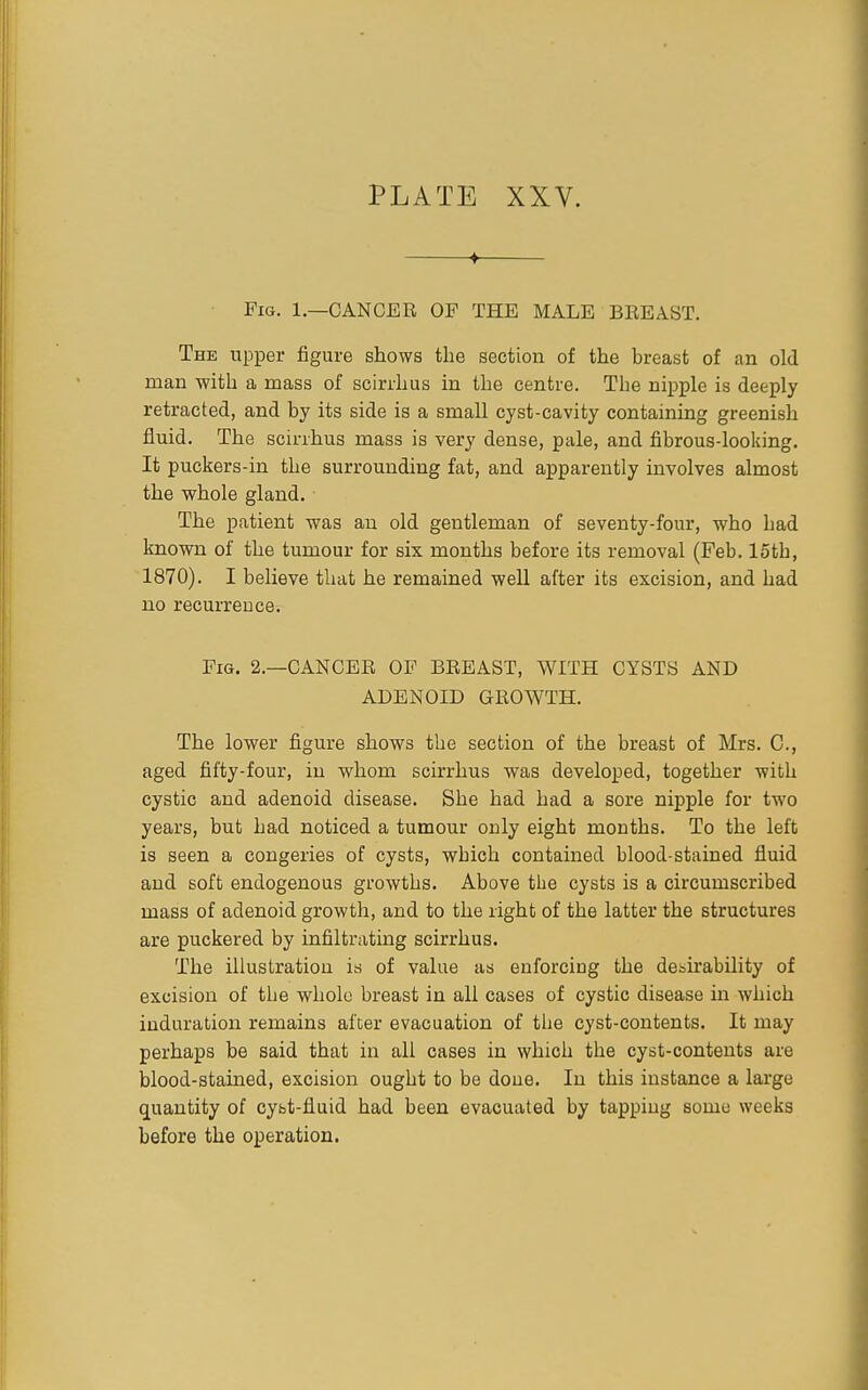 ♦ Fig. 1.—cancer OF THE MALE BREAST. The upper figure shows the section of the breast of an old man with a mass of scirrhus in the centre. The nipple is deeply retracted, and by its side is a small cyst-cavity containing greenish fluid. The scirrhus mass is very dense, pale, and fibrous-looking. It puckers-in the surrounding fat, and apparently involves almost the whole gland. The patient was an old gentleman of seventy-four, who had known of the tumour for six months before its removal (Feb. 15th, 1870). I believe that he remained well after its excision, and had no recurrence. Fig. 2.—cancer OF BREAST, WITH CYSTS AND ADENOID GROWTH. The lower figure shows the section of the breast of Mrs. C, aged fifty-four, in whom scirrhus was developed, together with cystic and adenoid disease. She had had a sore nipple for two years, but had noticed a tumour only eight months. To the left is seen a congeries of cysts, which contained blood-stained fluid and soft endogenous growths. Above the cysts is a circumscribed mass of adenoid growth, and to the right of the latter the structures are puckered by infiltrating scirrhus. The illustration is of value as enforcing the desirability of excision of the whole breast in all cases of cystic disease in which induration remains after evacuation of the cyst-contents. It may perhaps be said that in all oases in which the cyst-contents are blood-stained, excision ought to be doue. In this instance a large quantity of cyst-fluid had been evacuated by tapping some weeks before the operation.