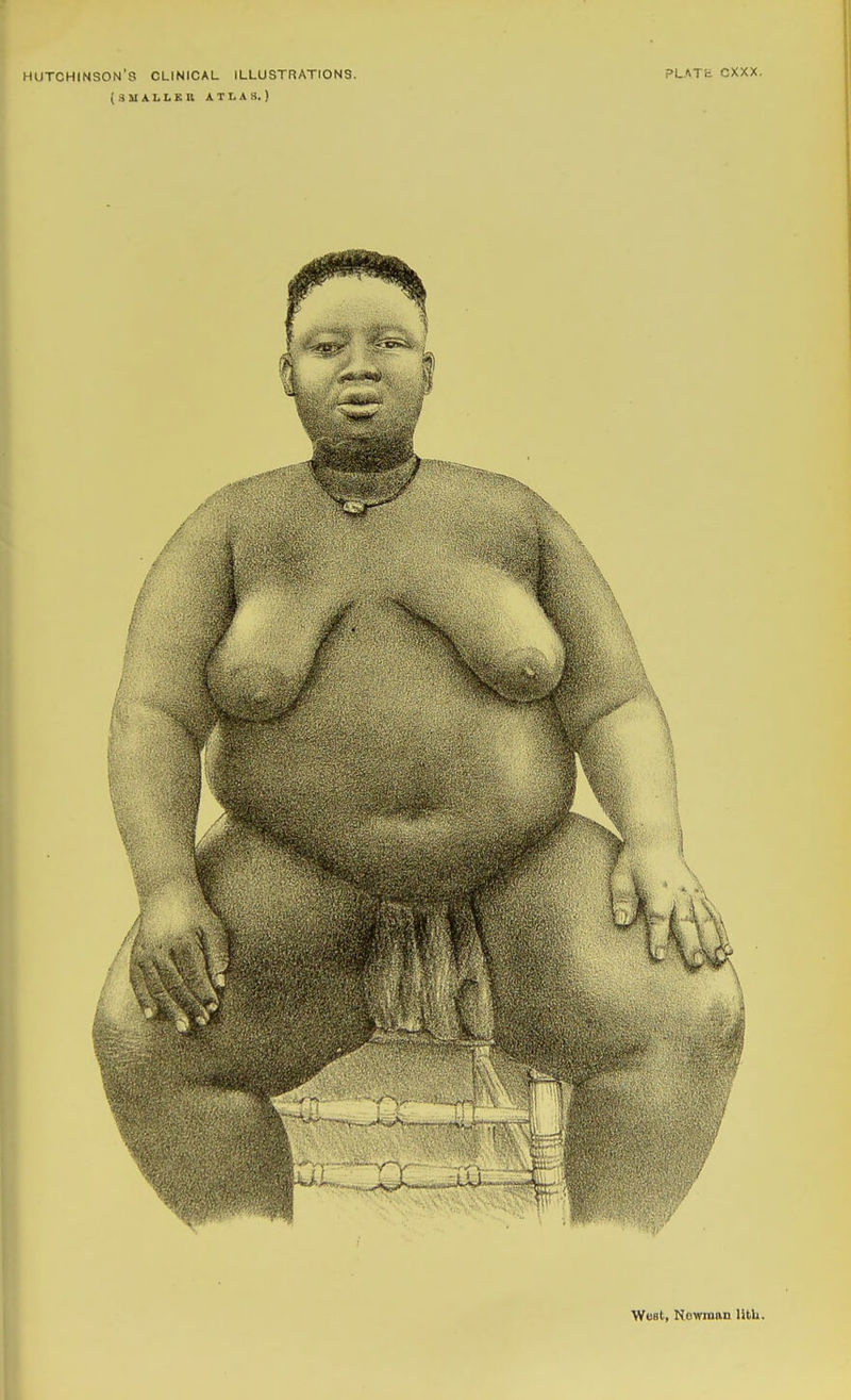 HUTCHINSON'S CLINICAL ILLUSTRATIONS. (SUALLSn ATLAS.) PLATfe CXXX.