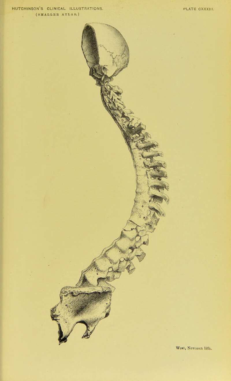 Hutchinson's clinical illustrations. (SMALLSB ATLAS.) PLATE CXXXIII. WoBt, Nflwiiiiin litli.