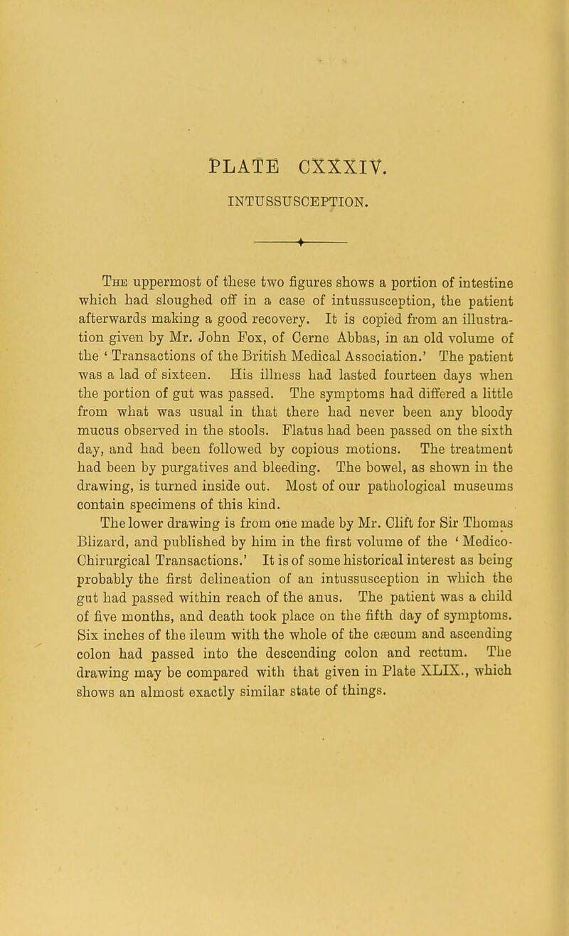 INTUSSUSCEPTION. 4 The uppermost of these two figures shows a portion of intestine which had sloughed off in a case of intussusception, the patient afterwards making a good recovery. It ia copied from an illustra- tion given by Mr. John Pox, of Cerne Abbas, in an old volume of the ' Transactions of the British Medical Association.' The patient was a lad of sixteen. His illness had lasted fourteen days when the portion of gut was passed. The symptoms had differed a little from what was usual in that there had never been any bloody mucus observed in the stools. Flatus had beeu passed on the sixth day, and had been followed by copious motions. The treatment had been by purgatives and bleeding. The bowel, as shown in the drawing, is turned inside out. Most of our pathological museums contain specimens of this kind. The lower drawing is from one made by Mr. Clift for Sir Thomas Blizard, and published by him in the first volume of the ' Medico- Chirurgical Transactions.' It is of some historical interest as being probably the first delineation of an intussusception in which the gut had passed within reach of the anus. The patient was a child of five months, and death took place on the fifth day of symptoms. Six inches of the ileum with the whole of the c^cum and ascending colon had passed into the descending colon and rectum. The drawing may be compared with that given in Plate XLIX., which shows an almost exactly similar state of things.