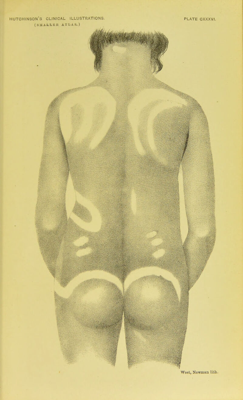 HUTCHINSON'S CLINICAL ILLUSTRATIONS. PLATE CXXXVI. (SMAIiLCU ATLAS.)