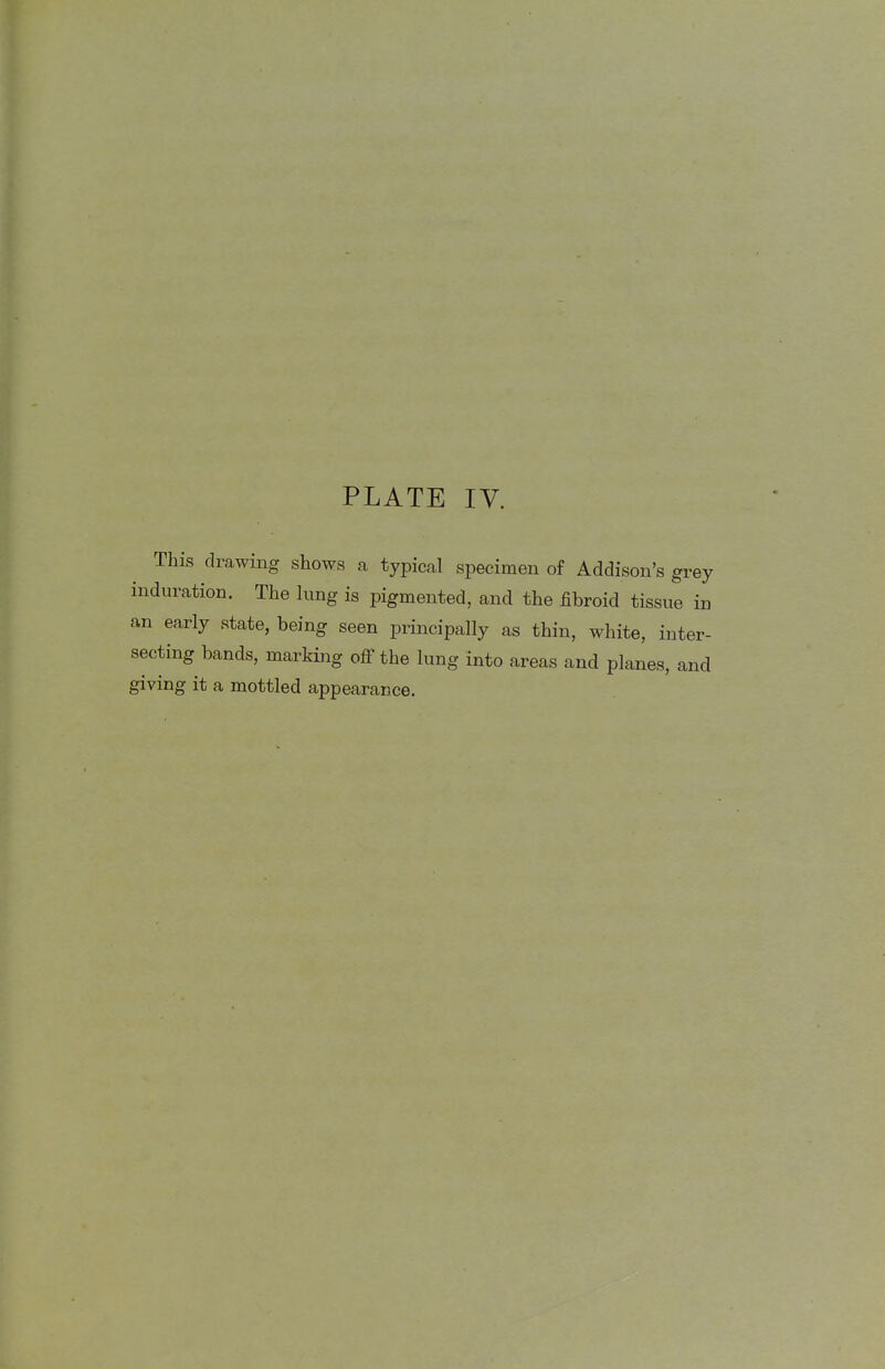 This drawing shows a typical specimen of Addison's grey induration. The lung is pigmented, and the fibroid tissue in an early state, being seen principally as thin, white, inter- secting bands, marking off the lung into areas and planes, and giving it a mottled appearance.