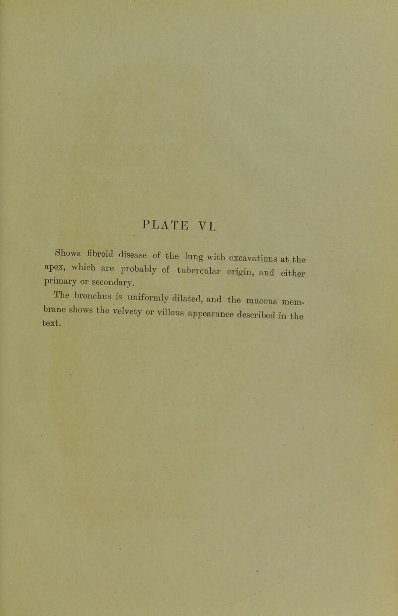 Shows fibroid disease of the lung with excavations at the apex, which are probably of tubercular origin, and either primary or secondary. The bronchus is uniformly dilated, and the mucous mem- brane shows the velvety or villous appearance described in the text.