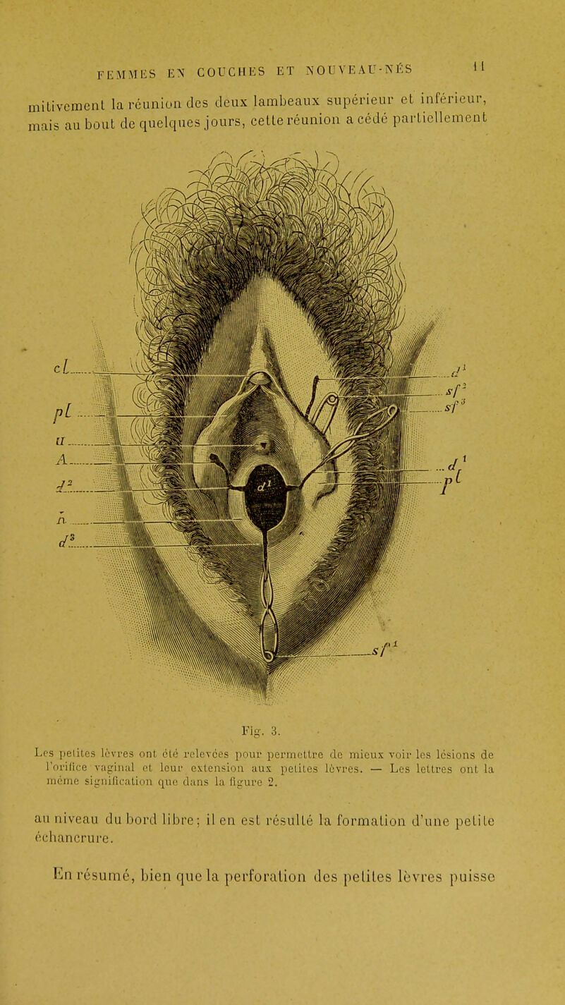 milivemenl la réunion des deux lambeaux supérieur et inférieur, mais au bout de quelques jours, celle réunion a cédé partiellement Fig. 3. Les jieiiles lèvres ont, élé rclevces pour permeUre de mieux voiries lésions de l'orilice vaginal el leur extension aux peliles lèvres. — Les lettres ont la même signification que dans la figure 2. au niveau du bord libre; il en est résulté la formation d'une petite cchancrure. En résumé, bien que la perforation des peliles lèvres puisse