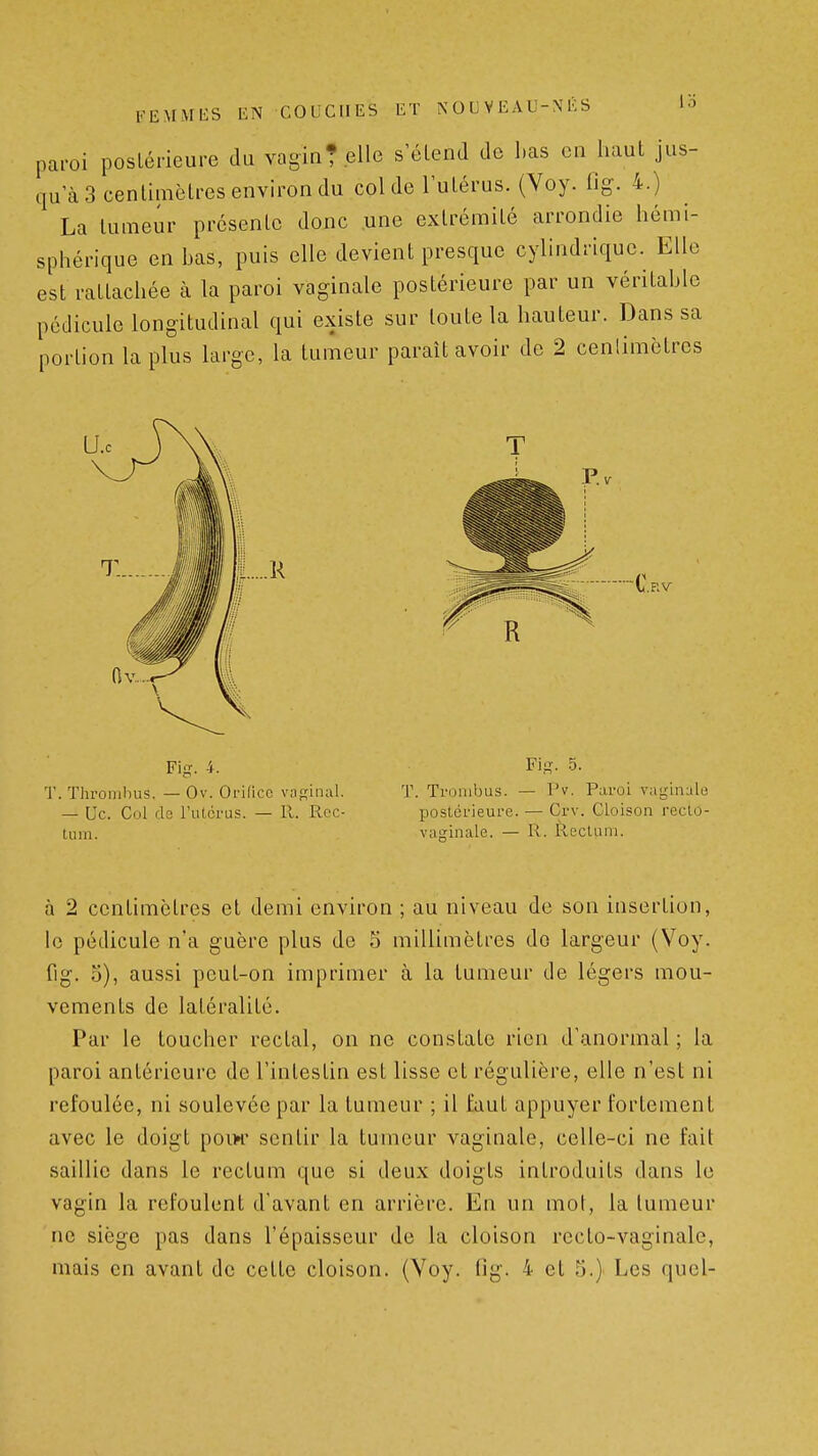 FEMMES EN COUCHES ET NOUVEAU-NÉS lo paroi postérieure du vagin?.elle s'élend de l.as eu haut jus- qu'à 3 centimètres environ du col de l'utérus. (Voy. fig. 4.) La tumeur présente donc une extrémité arrondie hémi- sphérique en has, puis elle devient presque cylindrique. Elle est rattachée à la paroi vaginale postérieure par un véritahle pédicule longitudinal qui existe sur toute la hauteur. Dans sa portion la plus large, la tumeur paraît avoir de 2 cenlimètres R Fi-. 4. T. Tlirombus. — Ov. Orifice vaginal. — Uc. Coi ds l'utérus. — 11. Rec- tum. Fig. 5. T. Trombus. — Pv. Paroi vaginale postérieure. — Crv. Cloison recto- vasinale. — R. Rectum. à 2 centimètres et demi environ ; au niveau de son insertion, le pédicule n'a guère plus de 5 millimètres do largeur (Voy. fig. o), aussi peut-on imprimer à la tumeur de légers mou- vements de latéralité. Par le toucher rectal, on ne constate rien d'anormal ; la paroi antérieure de l'intestin est lisse et régulière, elle n'est ni refoulée, ni soulevée par la tumeur ; il faut appuyer fortement avec le doigt pow sentir la tumeur vaginale, celle-ci ne fait saillie dans le rectum que si deux doigts introduits dans le vagin la refoulent d'avant en arrière. En un mot, la tumeur ne siège pas dans l'épaisseur de la cloison recto-vaginale,