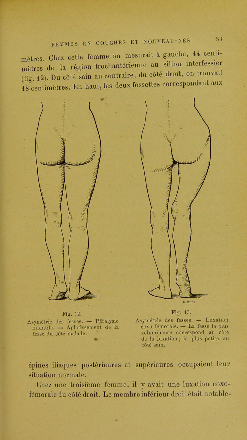 mètres Chez cette femme on mesurait à gauche, 14 centi- mètres de la région trochantérienne au sillon interfessier (fio- 12) Du côté sain au contraire, du côté droit, on trouvait IS^centimètres. En haut, les deux fossettes correspondant aux Fig. 12. Asymétrie des fesses. — PJCi-alysie infantile. — Aplatissement de la fesse du côté malade. Asymétrie des fesses. — Luxation coxo-fémorale. — La fesse la plus volumineuse correspond au côté de la luxation; la plus petite, au côté sain. épines iliaques postérieures et supérieures occupaient leur situation normale. Chez une troisième femme, il y avait une luxation coxo- fémorale du côté droit. Le membre inférieur droit était notable-