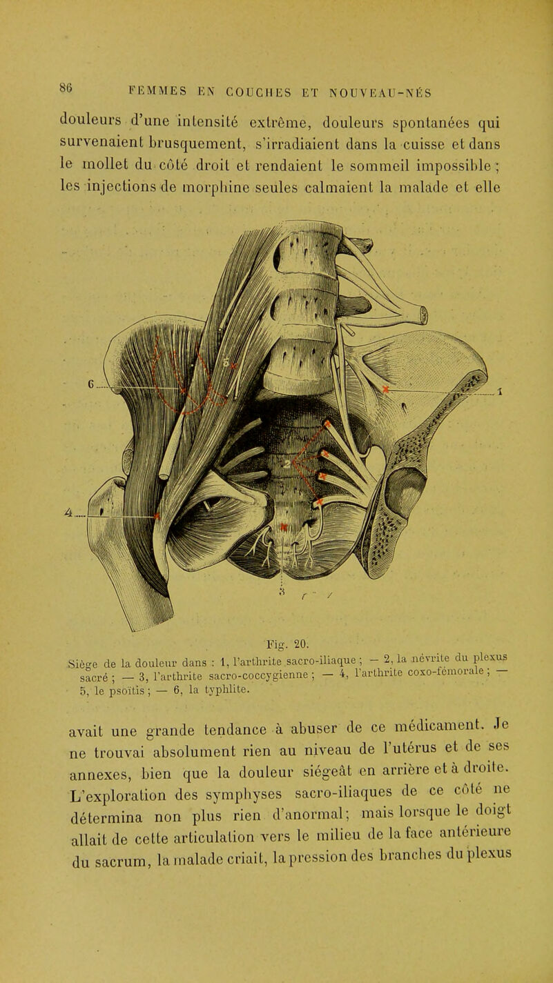 douleurs d'une intensité extrême, douleurs spontanées qui survenaient brusquement, s'irradiaient dans la cuisse et dans le mollet du. côté droit et rendaient le sommeil impossible ; les injections de morpbine seules calmaient la malade et elle .-1 Fig. 20. Siège de la douleur dans : 1, l'arllu-Ue sacro-iliaque ; - 2, la ncvrile du plexus sacré; - 3, l'arthrite sacro-coccygienne ; - 4, larthrile coxo-fcmorale ; - 5, le psoïtis ; — 6, la lyphlite. avait une grande tendance à abuser de ce médicament. Je ne trouvai absolument rien au niveau de l'utérus et de ses annexes, bien que la douleur siégeât en arrière et à droite. L'exploration des symphyses sacro-iliaques de ce côté ne détermina non plus rien d'anormal; mais lorsque le doigt allait de cette articulation vers le milieu de la face antérieure du sacrum, la malade criait, la pression des branches du plexus