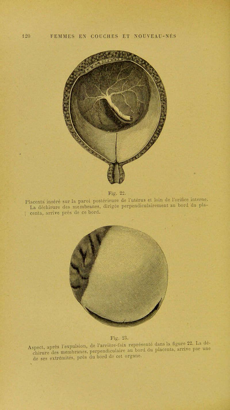 Fig. 2-2. Placenta inséré sur la paroi postérieure de l'utérus et loin de l'orifice interne. La déchirure des membranes, dirigée perpendiculairement au bord du pla- I centa, arrive près de ce bord. Fig. 23. A<,nect anrès l'expulsion, de l'arricro-lais représenté dans la figure 22. La dc- chirure'des membranes', perpendiculaire au bord du placenta, arrxvc par une de ses extrémités, près du bord de cet organe.