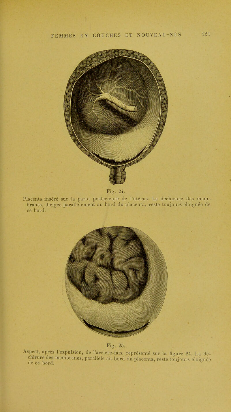 Fig. 24. Placenta inséré sur la i^aroi postérieure de l'utérus. La déchirure des mem- branes, dirigée parallèlement au bord du placenta, reste toujours éloignée de ce bord. Fig. 25. Aspect, après l'expulsion, do l'arriére-fais représenté sur la ligure 24. La dé- chirure des membranes, parallèle au bord du placenta, reste toujours éloignée dn cp bord.