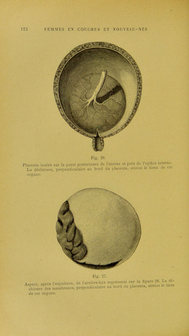 Fig. 27. Asnect après l'expulsion, de rarrière-faix représente sur la figure 20 La dc- cl'irure'des membranes, perpendiculaire au bord du placenta, atteu.t le tis.u de cet organe.