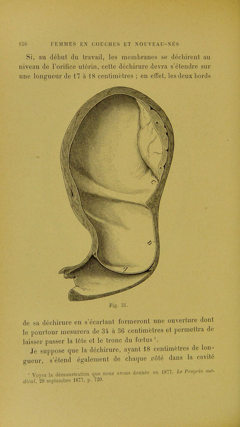Si, au début du travail, les membranes se déchirent au niveau de l'orifice utérin, celte déchirure devra s'étendre sur une longueur de 17 à 18 centimètres ; en effet, les deux bords Fig. 31. de sa déchirure en s'écartant formeront une ouverture dont le pourtour mesurera de 34 à 36 centimètres et permettra de laisser passer la tête et le tronc du fœtus '. Je suppose que la déchirure, ayant 18 centimètres de lon- gueur, s'étend également de chaque côté dans la cavité ■ Voyez la démonstration que nous avons donnée en 1877. Le l'roçirès mé- dical, 29 septembre 1877, p. 720.