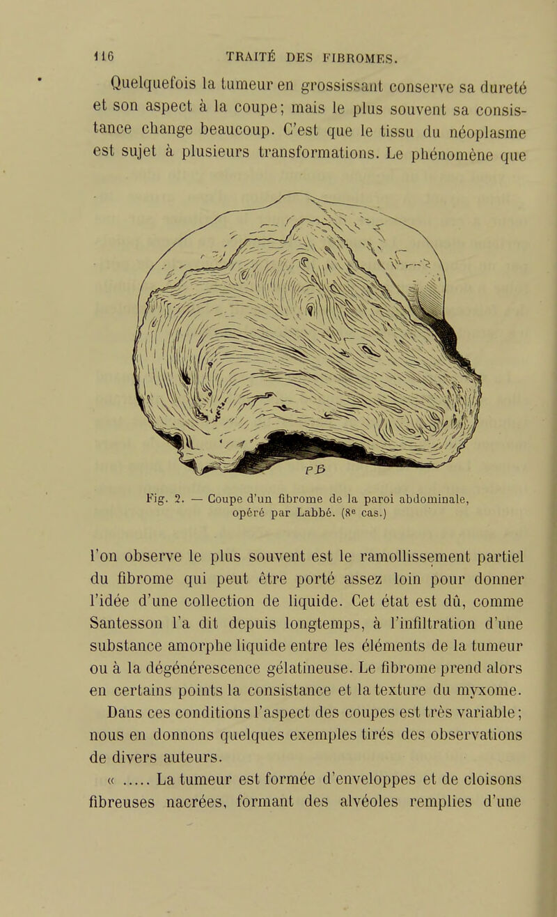 Quelquefois la tumeur en grossissant conserve sa dureté et son aspect à la coupe ; mais le plus souvent sa consis- tance change beaucoup. C'est que le tissu du néoplasme est sujet à plusieurs transformations. Le phénomène que Fig. 2. — Coupe d'un fibrome de la paroi abdominale, opéré par Labbé. (Re cas.) l'on observe le plus souvent est le ramollissement partiel du fibrome qui peut être porté assez loin pour donner l'idée d'une collection de liquide. Cet état est dû, comme Santesson l'a dit depuis longtemps, à l'infiltration d'une substance amorphe liquide entre les éléments de la tumeur ou à la dégénérescence gélatineuse. Le fibrome prend alors en certains points la consistance et la texture du myxome. Dans ces conditions l'aspect des coupes est très variable; nous en donnons quelques exemples tirés des observations de divers auteurs. « La tumeur est formée d'enveloppes et de cloisons fibreuses nacrées, formant des alvéoles remplies d'une