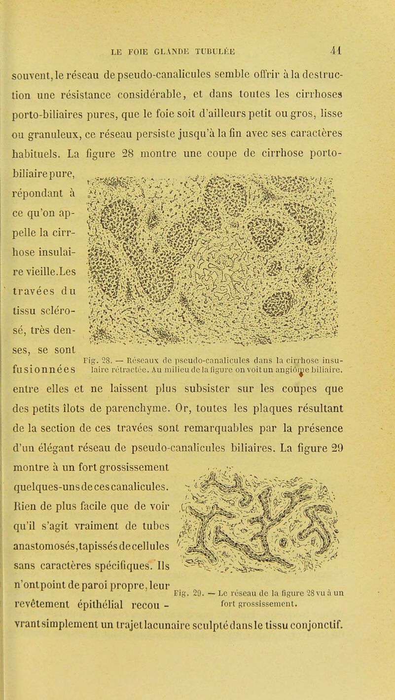souvent, le réseau de pseudo-canalicules semble offrir à la destruc- tion une résistance considérable, et dans toutes les cirrhoses porto-biliaires pures, que le foie soit d'ailleurs petit ou gros, lisse ou granuleux, ce réseau persiste jusqu'à la fin avec ses caractères habituels. La figure 28 montre une coupe de cirrhose porto- ses, se sont Fig. 28. — Réseaux de pseudo-canalicules clans la cirrhose insu- fusionnees laire rétractée. Au milieu de la ligure on voit un angiome biliaire. entre elles et ne laissent plus subsister sur les coupes que des petits îlots de parenchyme. Or, toutes les plaques résultant de la section de ces travées sont remarquables par la présence d'un élégant réseau de pseudo-canalicules biliaires. La figure 29 montre à un fort grossissement quelques-uns de ces canalicules. Rien de plus facile que de voir qu'il s'agit vraiment de tubes anastomosés,tapissésdecellules sans caractères spécifiques. Ils n'ontpoint de paroi propre, leur Fig. 29. — Le réseau de la figure 28 vu à un revêtement épithélial recou - fort grossissement, vrantsimplement un trajet lacunaire sculpté clans le tissu conjonclif.