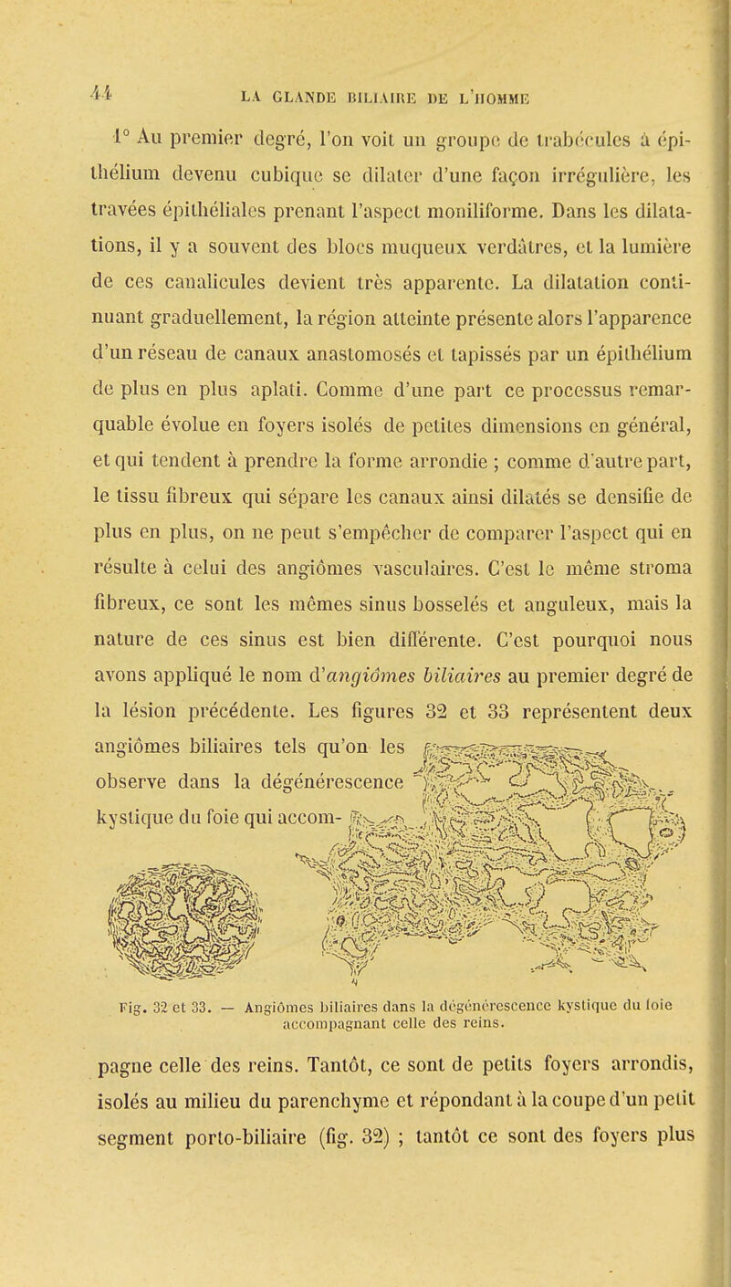 1° Au premier degré, l'on voit un groupe, de trabécules à épi- thélium devenu cubique se dilater d'une façon irrégulière, les travées épithéliales prenant l'aspect moniliforme. Dans les dilata- tions, il y a souvent des blocs muqueux verdàtres, et la lumière de ces canalicules devient très apparente. La dilatation conti- nuant graduellement, la région atteinte présente alors l'apparence d'un réseau de canaux anastomosés et tapissés par un épilbélium de plus en plus aplati. Comme d'une part ce processus remar- quable évolue en foyers isolés de petites dimensions en général, et qui tendent à prendre la forme arrondie ; comme d'autre part, le tissu fibreux qui sépare les canaux ainsi dilatés se densifie de plus en plus, on ne peut s'empêcher de comparer l'aspect qui en résulte à celui des angiomes vasculaires. C'est le même stroma fibreux, ce sont les mêmes sinus bosselés et anguleux, mais la nature de ces sinus est bien différente. C'est pourquoi nous avons appliqué le nom d'angiomes biliaires au premier degré de la lésion précédente. Les figures 32 et 33 représentent deux angiomes biliaires tels qu'on les B^^Viwii^^^ observe dans la dégénérescence ^UtOr^w^P^' - kystique du foie qui accom- ft^^ J'S?.§.^^^^^^Vf*^^% Fig. 32 et 33. — Angiomes biliaires dans la dégénérescence kystique du loie accompagnant celle des reins. pagne celle des reins. Tantôt, ce sont de petits foyers arrondis, isolés au milieu du parenchyme et répondant à la coupe d'un petit segment porto-biliaire (fig. 32) ; tantôt ce sont des foyers plus