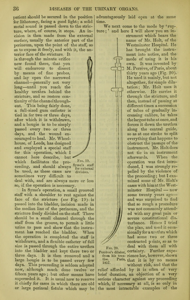 patient should be secured in the position for lithotomy, facing a good light; a solid metal sound is passed down to the stric- ture, where, of course, it stops. An in- cision is then made from the external surface, usually the anterior part of the perineum, upon the point of the staff, so as to expose it freely, and with it, the an- terior face of the stricture. It is through the minute orifice now found there, that you will endeavour to dissect by means o£ fine probes, and lay open the narrowed channel—generally not very long—until you reach the healthy urethra behind the stricture, and so restore con- tinuity of the channel through- out. This being fairly done, a full-sized gum catheter is tied in for two or three days, after which it is withdrawn, and a bougie is to be simply passed every two or three days, and the wound en- fj couraged to heal. Mr. Wheel- // house, of Leeds, has designed // and employed a special staff y for this operation, which I ^^f^ cannot liere describe, but which facilitates the pro- ceeding, and should always ^grexterail be used, as these cases are division, sometimes very difficult to deal with, and are always more or less so, if the operation is necessary. In Syme's operation, a small grooved staff with a shoulder to rest against the face of the stricture (see Fig. 19) is passed into the bladder, incision made in the median line of the perineum, and the stricture freely divided on the staflf. There should be a small channel through the staff from the groove, to permit a little urine to pass and show that the instru- ment has reached the bladder. When the operation is completed the staflf is withdrawn, and a flexible catheter of full size is passed through the entire urethra into the bladder and kept there two or three days. It is then removed and a large bougie is to be passed every few days. This proceeding is seldom adopted now, although much done twelve or fifteen years ago ; but other means have superseded it. It is usual now to reserve it chiefly for cases in which there are old or large perineal fistula? Avhich may be advantageously laid open at the same time. We next come to the mode by ' rup- ture ; ' and here I will show you an in- strument which bears the name of Mr. Holt, of the Westminster Hospital. He has brouo;ht the instru- ment into notice, and the mode of using it is his own. It was invented by M. Perreve, of Paris, about thirty years ago (Fig. 20). He used it mainly, but not altogether, for simple dila- tation ; Mr. Holt uses it otherwise. He carries it through the stricture, and then, instead of passing at different times a succession of tubes of gradually in- creasing calibre, he takes the largest tube at once, and forces it down the urethra along the central guide, so as at one stroke to split everything that happens to obstruct the passage of the instrument. Mr. Holt does not tie in an instrument afterwards. When the operation was first intro- duced, I was strongly re- pelled by the violence of the proceeding; but I exa- mined some of Mr. Holt's cases with him at the West- minster Hospital — now some twenty years ago— and was surprised to find that so rough a procedure was not commonly attend- ed with any great pain or severe constitutional dis- turbance. Hence I tried the plan, and used it occa- sionally for a urethra which had some two or three contracted points, so as to Fig 20 ^^^^ ^^^^ them all with Perrfeve's dilator, certainty. Further expe- from his trea- rience haF, however, shown Pans, £g \yy no means without risk, and that the relief afiforded by it is often of very brief duration, an objection of a very serious character against any proceeding which, if necessary at all, is so only in the most intractable examples of the tise. 1857.