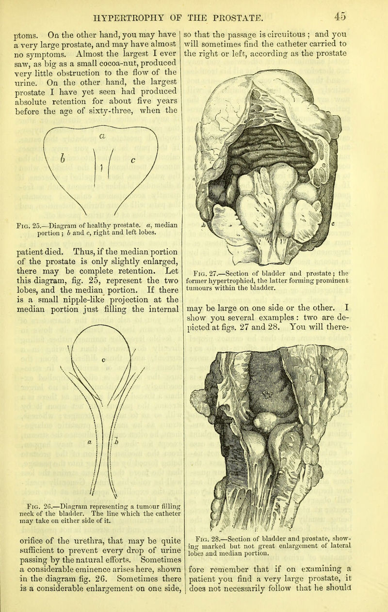 ptoms. On the other hand, you may have a very large prostate, and may have almost no symptoms. Almost the largest I ever saw, as big as a small cocoa-nut, produced very little obstruction to the flow of the urine. On the other hand, the largest prostate I have yet seen had produced absolute retention for about five years before the age of sixty-three, when the so that the passage is circuitous ; and you will sometimes find the catheter carried to the right or left, according as the prostate Fig. 25.—Diagram of healthy prostate, a, median portion ; h and c, right and left lobes. patient died. Thus, if the median portion of the prostate is only slightly enlarged, there may be complete retention. Let this diagram, fig. 25, represent the two lobes, and the median portion. If there is a small nipple-like projection at the median portion just filling the internal Fig. 2G.—Diagram representing a tumour filling neck of the bladder. The line Avhich the catheter may take on either side of it. orifice of the urethra, that may be quite suflScient to prevent every drop of urine passing by the natural efforts. Sometimes a considerable eminence arises here, shown in the diagram fig. 2G. Sometimes there is a considerable enlargement on one side. Fig. 27.—Section of bladder and prostate ; the former hypertrophied, the latter forming prominent tumours within the bladder. may be large on one side or the other. I show you several examples : two are de- picted at figs. 27 and 28. You will there- FiG. 28.—Section of bladder and prostate, shoAV- ing marked but not great enlargement of lateral lobe3 and median portion. fore remember that if on examining a patient you find a very large prostate, it does not necessarily follow that he should