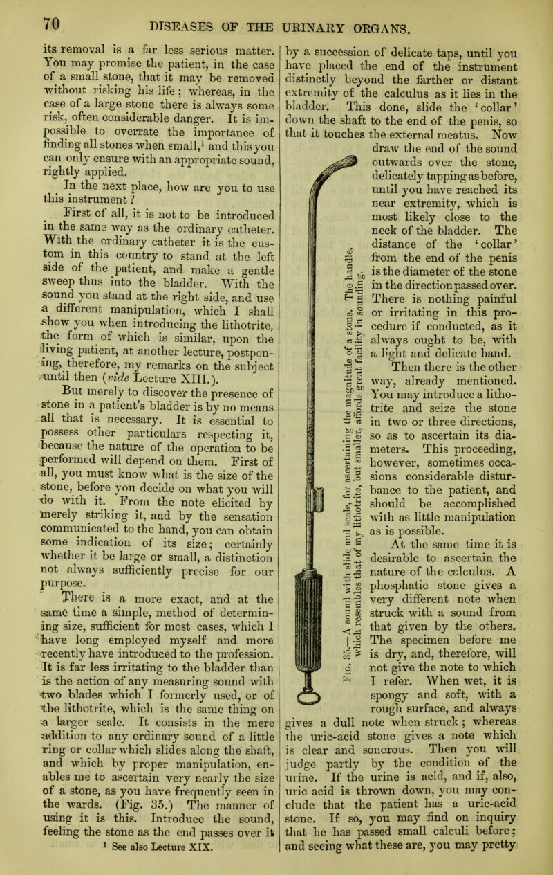 its removal is a far less serious matter. You may promise the patient, in the case of a small stone, that it may be removed without risking his life; whereas, in the case of a large stone there is always some risk, often considerable danger. It is im- possible to overrate the importance o£ finding all stones when small,^ and this you can only ensure with an appropriate sound, rightly applied. In the next place, how are you to use this instrument ? First of all, it is not to be introduced in the same way as the ordinary catheter. With the ordinary catheter it is the cus- tom in this country to stand at the left side of the patient, and make a gentle sweep thus into the bladder. With the sound you stand at the right side, and use a different manipulation, which I shall .show you when introducing the lithotrite, the form of which is similar, upon the living patient, at another lecture, postpon- ing, therefore, my remarks on the subject until then {vide Lecture XIII.). But merely to discover the presence of stone in a patient's bladder is by no means all that is necessary. It is essential to possess other particulars respecting it, because the nature of the operation to be :performed will depend on them. First of all, you must know what is the size of the :stone, before you decide on what you will -do with it. From the note elicited by merely striking it, and by the sensation communicated to the hand, you can obtain some indication of its size; certainly whether it be laige or smal], a distinction not always sufficiently precise for our purpose. There is a more exact, and at the same lime a simple, method of determin- ing size, sufficient for most cases, which I have long employed myself and more recently have introduced to the profession. It is far less irritating to the bladder than is the action of any measuring sound with ^wo blades which I formerly used, or of the lithotrite, which is the same thing on :a larger scale. It consists in the mere addition to any ordinary sound of a little ring or collar which slides along the shaft, and which by proper manipulation, en- ables me to ascertain very nearly the size of a stone, as you have frequently seen in the wards. (Fig. 35.) The manner of using it is this. Introduce the sound, feeling the stone as the end passes over it ^ See also Lecture XIX. 03 --S by a succession of delicate taps, until you have placed the end of the instrument distinctly beyond the farther or distant extremity of the calculus as it lies in the bladder. This done, slide the 'collar' down the shaft to the end of the penis, so that it touches the external meatus. Now draw the end of the sound outwards over the stone, delicately tapping as before, until you have reached its near extremity, which is most likely close to the neck of the bladder. The distance of the ' collar' from the end of the penis is the diameter of the stone in the direction passed over. There is nothing painful or irritating in this pro- cedure if conducted, as it always ought to be, with a light and delicate hand. Then there is the other way, already mentioned. You may introduce a litho- trite and seize the stone in two or three directions, so as to ascertain its dia- meters. This proceeding, however, sometimes occa- sions considerable distur- bance to the patient, and should be accomplished with as little manipulation as is possible. At the same time it is desirable to ascertain the nature of the calculus. A phosphatic stone gives a very different note when struck with a sound from that given by the others. The specimen before me is dry, and, therefore, will not give the note to which I refer. When wet, it is spongy and soft, with a rough surface, and always gives a dull note when struck; whereas the uric-acid stone gives a note which is clear and sonorous. Then you will judge partly by the condition ef the urine. If the urine is acid, and if, also, uric acid is thrown down, you may con- clude that the patient has a uric-acid stone. If so, you may find on inquiry that he has passed small calculi before; and seeing what these are, you may pretty O r3