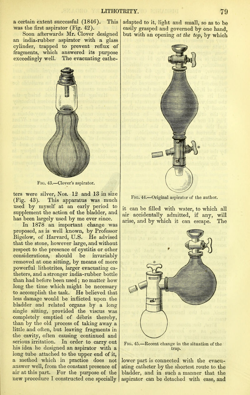a certain extent successful (1846). This was the first aspirator (Fig. 42). Soon afterwards Mr. Clover designed an india-rubber aspirator with a glass cylinder, trapped to prevent reflux of fragments, which answered, its purpose exceedingly well. The evacuating cathe- FiG. 43.—Clover's aspirator. ters were silver, Nos. 12 and 13 in size (Fig. 43). This apparatus was much used by myself at an early period to supplement the action of the bladder, and has been largely used by me ever since. In 1878 an important change was proposed, as is well known, by Professor Bigelow, of Harvard, U.S. He advised that the stone, however large, and without respect to the presence of cystitis or other considerations, should be invariably removed at one sitting, by means of more powerful lithotrites, larger evacuating ca- theters, and a stronger india-rubber bottle than had before been used; no matter how long the time which might be necessary to accomplish the task. He believed that less damage would be inflicted upon the bladder and related organs by a long single sitting, provided the viscus was completely emptied of debris thereby, than by the old process of taking away a little and often, but leaving fragments in the cavity, often causing continued and serious irritation. In order to carry out his idea he designed an aspirator with a long tube attached to the upper end of it, a method which in practice does not answer well, from the constant presence of air at this part. For the purpose of the new procedure I constructed one specially adapted to it, light and small, so as to be easily grasped and governed by one hand, but with an opening at the top, by which Fig. 44.—Original aspirator of the author. it can be filled with water, to which all air accidentally admitted, if any, will arise, and by which it can escape. The Fig. 45.—Recent change in the situation of the trap. lower part is connected with the evacu- ating catheter by the shortest route to the bladder, and in such a manner that the aspirator can be detached with ease, and