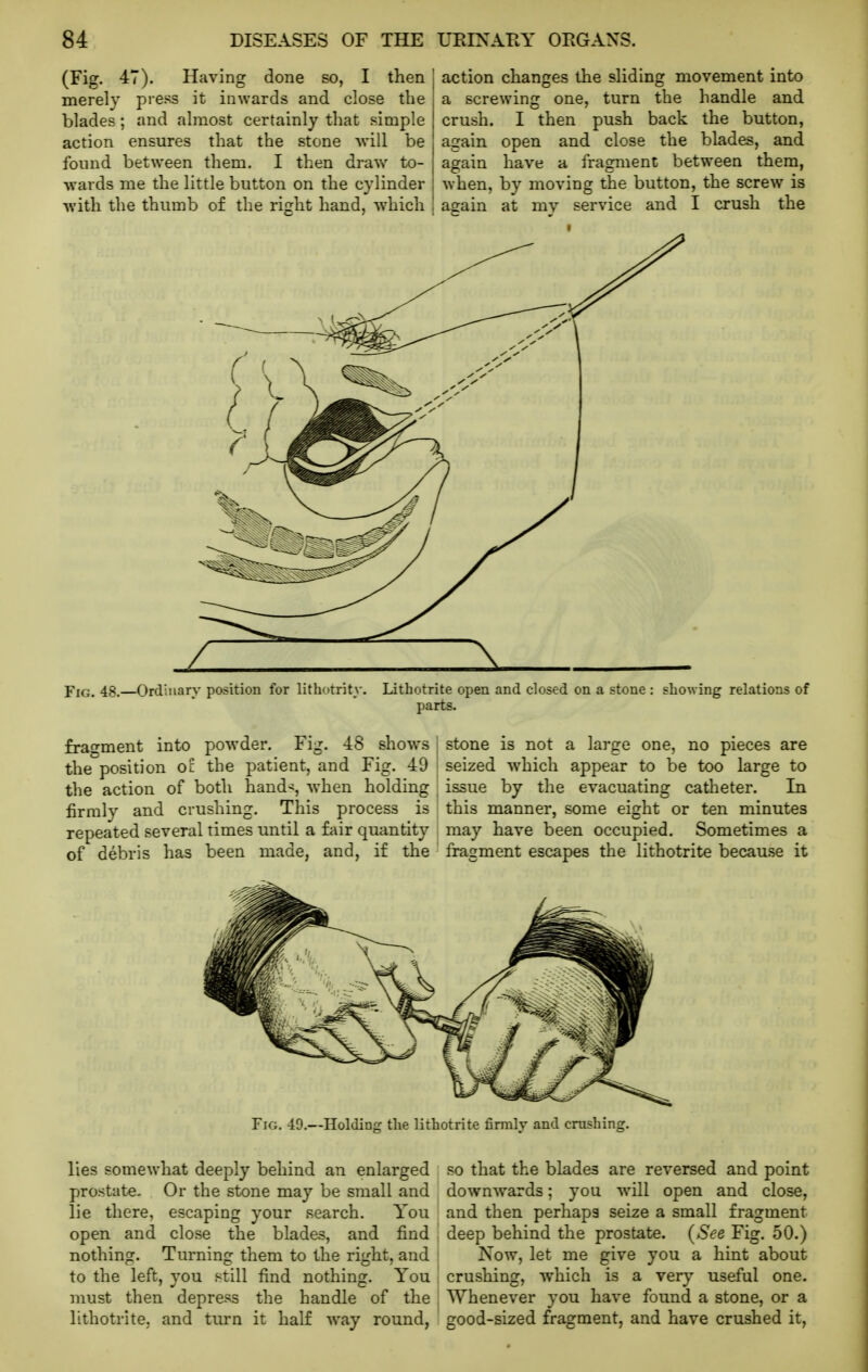 (Fig. 47). Having done so, I then merely press it inwards and close the blades; and almost certainly that simple action ensures that the stone will be found between them. I then draw to- wards me the little button on the cylinder with the thumb of the right hand, which action changes the sliding movement into a screwing one, turn the handle and crush. I then push back the button, again open and close the blades, and again have a fragment between them, when, by moving the button, the screw is again at mv service and I crush the YiG. 48.—Ordinary position for lithotrity. Lithotrite open and closed on a stone : showing relations of parts. fragment into powder. Fig. 48 shows the position o: the patient, and Fig. 49 the action of both hand^, -svhen holding firmly and crushing. This process is repeated several times until a fair quantity of debris has been made, and, if the stone is not a large one, no pieces are seized which appear to be too large to issue by the evacuating catheter. In this manner, some eight or ten minutes may have been occupied. Sometimes a fragment escapes the lithotrite because it Fig. 49.—Holding: the lithotrite firmlv and crushing. lies somewhat deeply behind an enlarged prostate. Or the stone may be small and lie there, escaping your search. You open and close the blades, and find nothing. Turning them to the right, and to the left, you still find nothing. You must then depress the handle of the lithotrite, and tiu'n it half way round, .so that the blades are reversed and point downwards; you will open and close, and then perhaps seize a small fragment I deep behind the prostate. (See Fig. 50.) I Now, let me give you a hint about crushing, which is a very useful one. Whenever you have found a stone, or a good-sized fragment, and have crushed it.