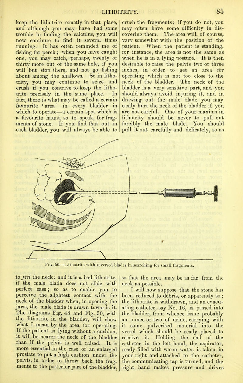 keep the litliotrite exactly in that place, and although you may have had some trouble in finding the calculus, you will now continue to find it several times running. It has often reminded me of fishing for perch ; when you have caught one, you may catch, perhaps, twenty or thirty more out of the same hole, if you will but stop there, and not go fishing about among the shallows. So in litho- trity, you may continue to seize and crush if you contrive to keep the litho- trite precisely in the same place. In fact, there is what may be called a certain favourite ' area' in every bladder in which to operate—a certain spot which is a favourite haunt, so to speak, for frag- ments of stone. If you find that out in each bladder, you will always be able to crush the fragments; if you do not, you may often have some difficulty in dis- covering them. The area will, of course, vary somewhat with the position of the patient. When the patient is standing, for instance, the area is not the same as when he is in a lying posture. It is then desirable to raise the pelvis two or three inches, in order to get an area for operating which is not too close to the neck of the bladder. The neck of the bladder is a very sensitive part, and you should always avoid injuring it, and in drawing out the male blade you may easily hurt the neck of the bladder if you are not careful. One of your maxims in lithotrity should be never to pull out forcibly the male blade. You should pull it out carefully and delicately, so as Fig. 50.—Litliotrite with reversed blades in searching for small fragments to feel the neck ; and it is a bad lithotrite, if the male blade does not slide with perfect ease; so as to enable you to perceive the slightest contact with the neck of the bladder when, in opening the jaws, the male blade is drawn towards it. The diagrams Fig. 48 and Fig. 50, with the lithotrite in the bladder, will show what I mean by the area lor operating. If the patient is lying without a cushion, it will be nearer the neck of the bladder than if the pelvis is well raised. It is more essential in the case of an enlarged prostate to put a high cushion under the pelvis, in order to throw back the frag- ments to the posterior part of the bladder, so that the area may be as far from the neck as possible. I will now suppose that the stone has been reduced to debris, or apparently so; the lithotrite is withdrawn, and an evacu- ating catheter, say No. 16, is passed into the bladder, from whence issue probably an ounce or two of urine, carrying with it some pulverised material into the vessel which should be ready placed to receive it. Holding the end of the catheter in the left hand, the aspirator, ready filled with warm water, is taken in your right and attached to the catheter, the communicating tap is turned, and the right hand makes pressure and drives