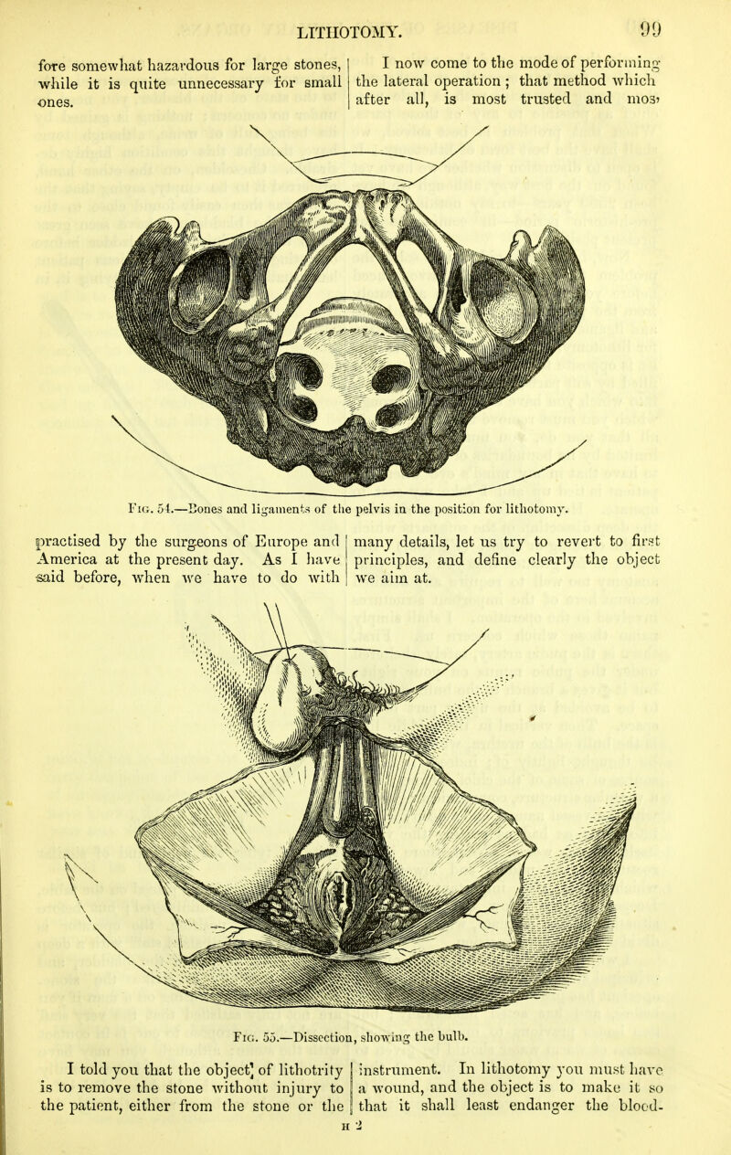 fore somewliat hazardous for large stones, I now come to the mode of performing- while it is quite unnecessary for small the lateral operation; that method which ones. after all, is most trusted and mos? Fig. 54.—Bones and lij^aments of the pelvis ia the position for lithotomy. practised by the surgeons of Europe and I many details, let us try to revert to first America at the present day. As 1 have principles, and define clearly the object ^id before, when we have to do with | we aim at. Fig, 55.—Dissection, showing the bulb. I told you that the object] of lithotrity is to remove the stone without injury to the patient, either from the stone or the instrument. In lithotomy you must have a wound, and the object is to make it so that it shall least endanger the blood-