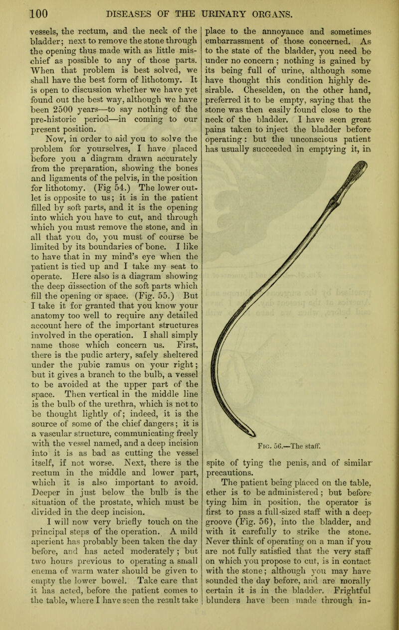 vessels, tlie rectum, and the neck of the bladder; next to remove the stone through the opening thus made with as little mis- chief as possible to any of those parts. When that problem is best solved, we shall have the best form of lithotomy. It is open to discussion whether we have yet found out the best way, although we have been 2500 years—to say nothing of the pre-historic period—in coming to our present position. Now, in order to aid you to solve the problem for yourselves, I have placed before you a diagram drawn accurately from the preparation, shoAving the bones and ligaments of the pelvis, in the position for lithotomy. (Fig 54.) The lower out- let is opposite to us; it is in the patient filled by soft parts, and it is the opening into Avhich you have to cut, and through which you must remove the stone, and in all that you do, you must of course be limited by its boundaries of bone. I like to have that in my mind's eye when the patient is tied up and I take my seat to operate. Here also is a diagram showing the deep dissection of the soft parts which fill the opening or space. (Fig. 55.) But I take it for granted that you know your anatomy too well to require any detailed account here of the important structures involved in the operation. I shall simply name those which concern us. First, there is the pudic artery, safely sheltered under the pubic ramus on your right; but it gives a branch to the bulb, a vessel to be avoided at the upper part of the space. Then vertical in the middle line is the bulb of the urethra, which is not to be thought lightly of; indeed, it is the source of some of the chief dangers; it is a vascular structure, communicating freely with the vessel named, and a deep incision into it is as bad as cutting the vessel itself, if not worse. Next, there is the rectum in the middle and lower part, which it is also important to avoid. Deeper in just below the bulb is the situation of the prostate, which must be divided in the deep incision. I will now very briefly touch on the principal steps of the operation. A mild aperient has probably been taken the day before, and has acted moderately ; but two hours previous to oj^erating a small enema of warm water should be given to empty the lower bowel. Take care that it has acted, before the patient comes to the table, where I have seen the result take place to the annoyance and sometimes embarrassment of those concerned. As to the state of the bladder, you need be under no concern ; nothing is gained by its being full of lu'ine, although some have thought this condition highly de- sirable. Cheselden, on the other hand^ preferred it to be empty, saying that the stone was then easily found close to the neck of the bladder. I have seen great pains taken to inject the bladder before operating: but the unconscious patient has usually succeeded in emptying it, in Fig. 56.—The staff. spite of tying the penis, and of similar- precautions. The patient being placed on the table, ether is to be administered; but before tying him in position, the operator is first to pass a full-sized staff with a deep groove (Fig. 56), into the bladder, and with it carefully to strike the stone. Never think of operating on a man if you are not fully satisfied that the very staff on which you propose to cut, is in contact with the stone; although you may have sounded the day before, and are morally certain it is in the bladder. Frightful blunders have been made through in-