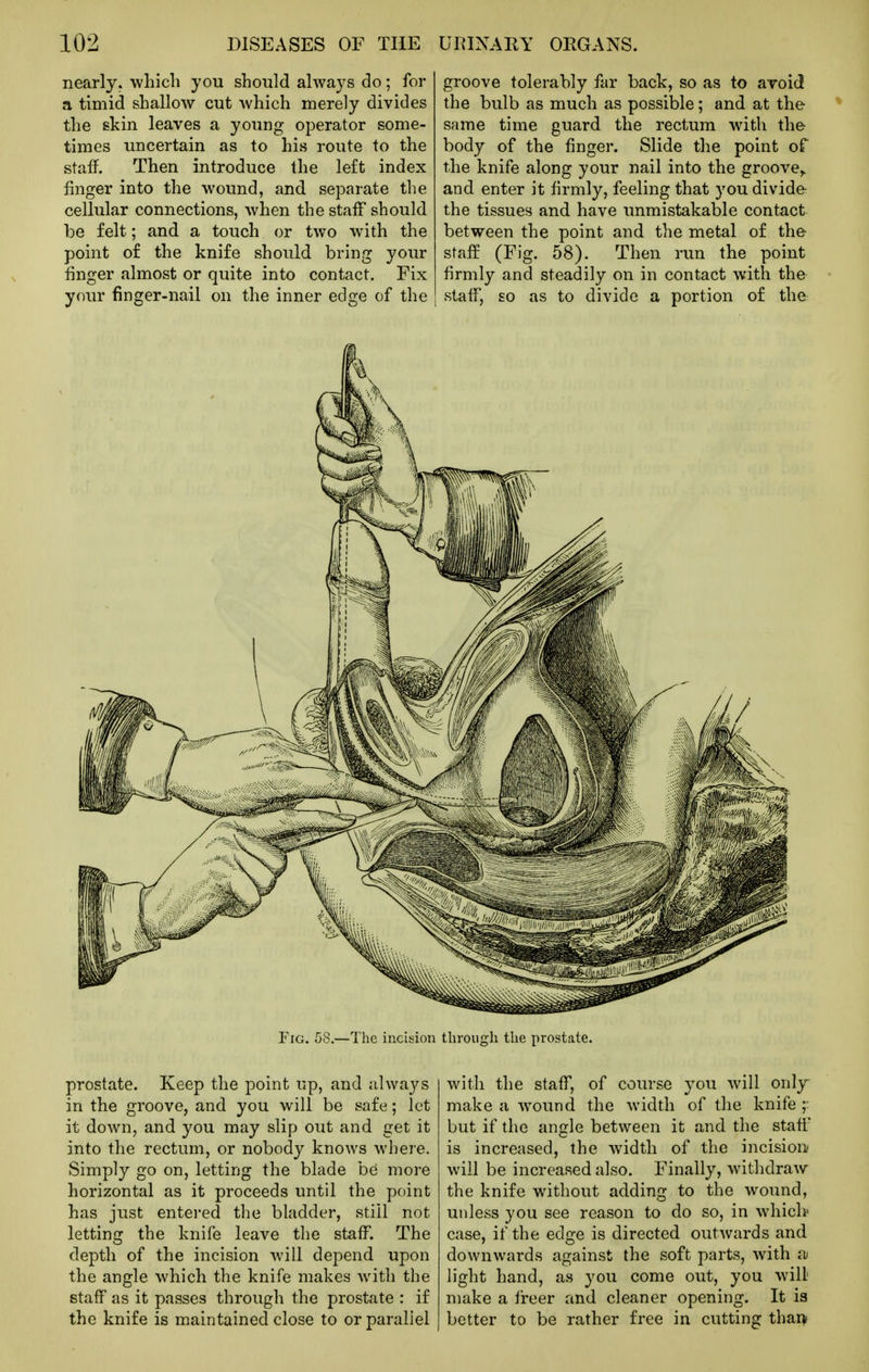 nearly, which you should always do; for a timid shallow cut which merely divides the skin leaves a young operator some- times uncertain as to his route to the staff. Then introduce the left index finger into the wound, and separate the cellular connections, when the staff should be felt; and a touch or two with the point of the knife should bring your finger almost or quite into contact. Fix your finger-nail on the inner edge of the groove tolerably far back, so as to avoid the bulb as much as possible; and at the same time guard the rectum with the body of the finger. Slide the point of the knife along your nail into the groove,, and enter it firmly, feeling that you divide the tissues and have unmistakable contact between the point and the metal of the staff (Fig. 58). Then run the point firmly and steadily on in contact with the staff, so as to divide a portion of the Fig. 58.—The incision through the prostate. prostate. Keep the point up, and always in the groove, and you will be safe; let it down, and you may slip out and get it into the rectum, or nobody knows where. Simply go on, letting the blade be more horizontal as it proceeds until the point has just entered the bladder, still not letting the knife leave the staff. The depth of the incision will depend upon the angle which the knife makes with the staff as it passes through the prostate : if the knife is maintained close to or parallel with the staff, of course you will only make a wound the width of the knife but if the angle between it and the staff is increased, the width of the incision will be increased also. Finally, withdraw the knife without adding to the wound, unless you see reason to do so, in which- case, if the edge is directed outwards and downwards against the soft parts, with a; light hand, as you come out, you will make a freer and cleaner opening. It is better to be rather free in cutting thai)!