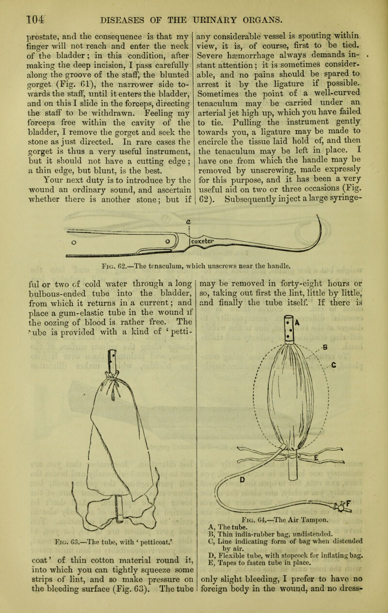 prostate, and the consequence is that my finger will not reach and enter the neck of the bladder; in this condition, after making the deep incision, I pass carefully along the groove of the staff, the blunted gorget (Fig. Gl), the narrower side to- wards the staff, until it enters the bladder, and on this I slide in the forceps, directing the staff to be withdrawn. Feeling my forceps free within the cavity of the bladder, I remove the gorget and seek the stone as just directed. In rare cases the gorget is thus a very useful instrument, but it should not have a cutting edge ; a thin edge, but blunt, is the best. Your next duty is to introduce by the wound an ordinary sound, and ascertain whether there is another stone; but if o ful or two of cold water through a long bulbous-ended tube into the bladder, from which it returns in a current; and place a gum-elastic tube in the wound if the oozing of blood is rather free. The *-ube is provided with a kind of ' petti- coat' o£ thin cotton material round it, into which you can tightly squeeze some strips of lint, and so make pressure on the bleeding surface (Fig. 63). The tube any considerable vessel is spouting within view, it is, of course, first to be tied. Severe hemorrhage always demands in- stant attention; it is sometimes consider- able, and no pains should be spared to arrest it by the ligature if possible. Sometimes the point of a well-curved tenaculum may be carried under ^ an arterial jet high up, which you have failed to tie. Pulling the instrument gently towards you, a ligature may be made to encircle the tissue laid hold of, and then the tenaculum may be left in place. I have one from which the handle may be removed by unscrewing, made expressly for this purpose, and it has been a very useful aid on two or three occasions (Fig. 62). Subsequently inject a large syringe- may be removed in forty-eight hours or so, taking out first the lint, little by little, and finally the tube itself. If there is • A Fig. G4.—The Air Tampon. A, The tube. P», Thin india-rubber bag, iindistenclecl. C, Line indicating form of bag when distended by air. D, Flexible tube, with stopcock for inflating bag. Tapes to fasten tube in place. only slight bleeding, I prefer to have no foreign body in the wound, and no dress- Fig. G2.—The tenaculum, which unscrews near the handle.