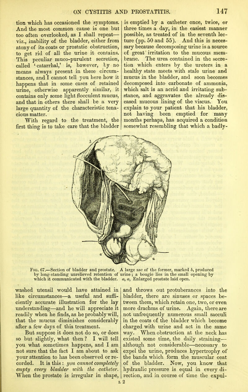 tion which has occasioned the symptoms. And the most common cause is one but too often overlooked, as I shall repeat— viz., inability of the bladder, either from atony of its coats or prostatic obstruction, to get rid of all the urine it contains. This pecuhar muco-purulent secretion, called 'catarrhal,' is, however, by no means always present in these circum- stances, and I cannot tell you here how it happens that in some cases of retained urine, otherwise apparently similar, it contains only some light flocculent mucus, and that in others there shall be a very large quantity of the characteristic tena- cious matter. With regard to the treatment, the first thing is to take care that the bladder is emptied by a catheter once, twice, or three times a day, in the easiest manner possible, as treated of in the seventh lec- ture (pp. 50 and 55). And this is neces- sary because decomposing urine is a source of great' irritation to the mucous mem- brane. The urea contained in the secre- tion which enters by the ureters in a healthy state meets with stale urine and mucus in the bladder, and soon becomes decomposed into carbonate of ammonia, which salt is an acrid and irritating sub- stance, and aggravates the already dis- eased mucous lining of the viscus. You explain to your patient that his bladder, not having been emptied for many months perhaps, has acquired a condition somewhat resembling that which a badly- FiG. 67.—Section of bladder and prostate. A large sac of the former, marked b, produced by lonp:-standing unrelieved retention of urine; a bougie lies in the small opening by which it communicated with the bladder, a, a, Enlarged prostate laid open. washed utensil would have attained in like circumstances—a useful and sufii- ciently accurate illustration for the lay understanding—and he will appreciate it readily when he finds, as he probably will, that the mucus diminishes considerably after a few days of this treatment. But suppose it does not do so, or does so but slightly, what then ? I will tell you what sometimes happens, and I am not sure that the fact I am about to ask your attention to has been observed or re- corded. It is this : you cannot completely empty every bladder with the catheter. When the prostate is irregular in shape, and throws out protuberances into the bladder, there are sinuses or spaces be- tween them, which retain one, two, or even more drachms of urine. Again, there are not unfrequently numerous small sacculi in the coats of the bladder which become charged with urine and act in the same way. When obstruction at the neck has existed some time, the daily straining— although not considerable—necessary to expel the urine, produces hypertrophy of the bands which form the muscular coat o^ the bladder. Now, you know that hydraulic pressure is equal in every di- rection, and in course of time the expul- L 2