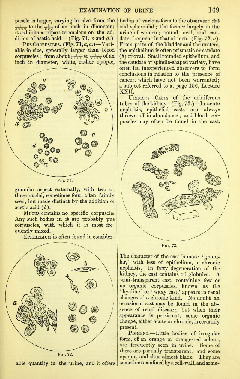 puscle is larger, varying in size from the BuVIT o£ an inch in diameter; it exhibits a tripartite nucleus on the ad- dition of acetic acid. (Fig. 71, c and d.) Pus Corpuscles. (Fig. 71,«, a.)—Vari- able in size, generally larger than blood corpuscles; from about -^-^-^ to 20^00 inch in diameter, white, rather opaque. Fio. 71. granular aspect externally, with two or three nuclei, sometimes four, often faintly seen, but made distinct by the addition of acetic acid (h). Mucus contains no specific corpuscle-. Any such bodies in it are probably pus corpuscles, with which it is most Ire- quently mixed. Epithelium is often found in consider- FiG. 7,2. able quantity in the urine, and it offers bodies of various form to the observer: flat and spheroidal; the former largely in the urine of women; round, oval, and cau- date, frequent in that of men. (Fig. 72, a). From parts of the bladder and the ureters, the epithelium is often prismatic or caudate (6) or oval. Small rounded epithelium, and the caudate or spindle-shaped variety, have often led inexperienced observers to form conclusions in relation to the presence of cancer, which have not been warranted; a subject referred to at page 156, Lecture XXII. Urinary Casts of the uriniferous tubes of the kidney. (Fig. 73.)—In acute nephritis, epithelial casts are always thrown off in abundance ; and blood cor- puscles may often be found in the cast. Fig. 73. The character of the cast is more ^ granu- lar,' with less of epithelium, in chronic nephritis. In fatty degeneration of the kidney, the cast contains oil globules. A semi-transparent cast, containing few or no organic corpuscles, known as the ' hyaline' or ' waxy cast,' appears in renal changes of a chronic kind. No doubt an occasional cast may be found in the ab- sence of renal disease; but when their appearance is persistent, some organic change, either acute or chronic, is certainly present. Pigment.—Little bodies of irregular form, of an orange or orange-red colour, are frequently seen in urine. Some of these are partially transparent; and some opaque, and thus almost black. They are sometimes confined by a cell-wall, and some-