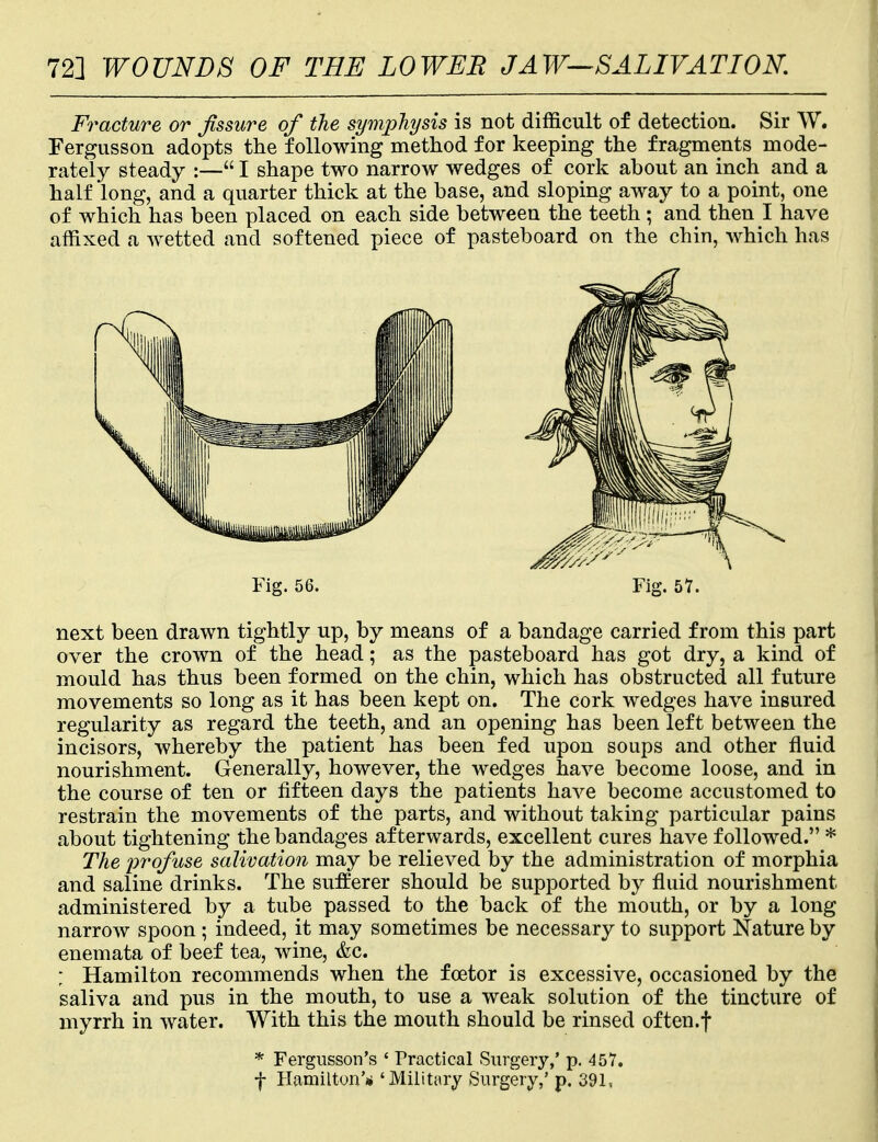 72] WOUNDS OF THE LOWER J AW—SALIVATION. Fracture or fissure of the symphysis is not difficult of detection. Sir W. Fergusson adopts the following method for keeping the fragments mode- rately steady :— I shape two narrow wedges of cork about an inch and a half long, and a quarter thick at the base, and sloping away to a point, one of which has been placed on each side between the teeth ; and then I have affixed a wetted and softened piece of pasteboard on the chin, which has next been drawn tightly up, by means of a bandage carried from this part over the crown of the head; as the pasteboard has got dry, a kind of mould has thus been formed on the chin, which has obstructed all future movements so long as it has been kept on. The cork wedges have insured regularity as regard the teeth, and an opening has been left between the incisors, whereby the patient has been fed upon soups and other fluid nourishment. Generally, however, the wedges have become loose, and in the course of ten or fifteen days the patients have become accustomed to restrain the movements of the parts, and without taking particular pains about tightening the bandages afterwards, excellent cures have followed. * The profuse salivation may be relieved by the administration of morphia and saline drinks. The sufferer should be supported by fluid nourishment administered by a tube passed to the back of the mouth, or by a long narrow spoon; indeed, it may sometimes be necessary to support Nature by enemata of beef tea, wine, &c. ; Hamilton recommends when the fcetor is excessive, occasioned by the saliva and pus in the mouth, to use a weak solution of the tincture of myrrh in water. With this the mouth should be rinsed often.f Fig. 56. Fig. 57. * Fergusson's ' Practical Surgery,' p. 457. f Hamilton'** 'Military Surgery/ p. 391,