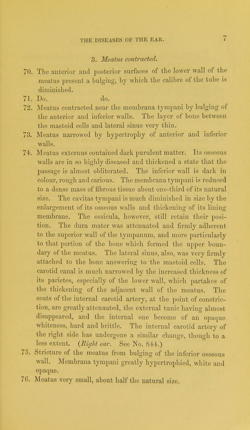 8. Meatus contracted. 70. The anterior and posterior surfaces of the lower wall of the meatus present a bulging, by which the calibre of the tube is diminished. 71. Do. do. 72. Meatus contracted near the membrana tympani by bulging of the anterior and inferior walls. The layer of bone between the mastoid cells and lateral sinus very thin. 73. Meatus narrowed by hypertrophy of anterior and inferior walls. 74. Meatus externus contained dark purulent matter. Its osseous walls are in so highly diseased and thickened a state that the passage is almost obliterated. The inferior wall is dark in colour, rough and carious. The membrana tympani is reduced to a dense mass of fibrous tissue about one-third of its natural size. The cavitas tympani is much diminished in size by the enlargement of its osseous walls and thickening of its lining membrane. The ossicula, however, still retain their posi- tion. The dura mater was attenuated and firmly adherent to the superior wall of the tympanum, and more particularly to that portion of the bone which formed the upper boun- dary of the meatus. The lateral sinus, also, was very firmly attached to the bone answering to the mastoid cells. The carotid canal is much narrowed by the increased thickness of its parietes, especially of the lower wall, which partakes of the thickening of the adjacent wall of the meatus. The coats of the internal carotid artery, at the point of constric- tion, are greatly attenuated, the external tunic having almost disappeared, and the internal one become of an opaque whiteness, hard and brittle. The internal carotid artery of the right side has undergone a similar change, though to a less extent. {Right ear. See No. 844.) 75. Stricture of the meatus from bulging of the inferior osseous wall. Membrana tympani greatly hypertrophied, white and opaque. 76. Meatus very small, about half the natural size.