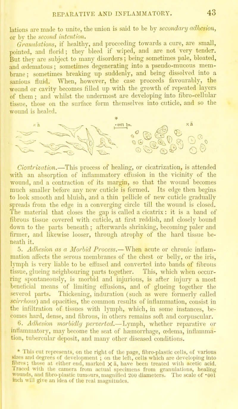 lations are made to unite, the union is said to be by secondary adhesion, or bv tlie second intention. Grctwtlittioiis, if healthy, and proceeding towards a cure, are small, pointed, and florid; they bleed if wiped, and are not veiy tender. But thev are subject to liiany disorders; bemg sometimes pale, bloated, and oedematous; sometimes degenerating into a pseudo-mucous mem- brane ; sometimes breaking up suddenly, and being dissolred into a sanious fluid. ^Vhen, however, the case proceeds favourably, the wound or cavity becomes filled up with the growth of repeated layers of them; and whilst the undei-most are developing into fibro-cellular tissue, those on the surface fonn themselves into cuticle, and so the wound is healed. Cicatrization.—This process of healing, or cicatrization, is attended with an absoi-ption of inflammatory eti'usion in the vicinity of the wound, and a contraction of its mai'gin, so that the wound becomes much smaller before any new cuticle is formed. Its edge then begins to look smooth and bluish, and a thin pellicle of new cuticle gradually spreads fi'om the edge in a converging circle till the wound is closed. The material that closes the gap is called a cicatrix: it is a band of fibrous tissue covered with cuticle, at first reddish, and closely bound down to the parts beneath ; afterwards shrinking, becoming paler and firmer, and likewise looser, through atrophy of the hard tissue be- neath it. 5. Adlwsion as a Morbid Process.— Wlien acute or clironic inflam- mation affects the serous membranes of the chest or belly, or the iris, lymph is very liable to be effused and converted into bands of fibrous tissue, glueing neighbouring parts together. This, whicli when occur- ring spontaneously, is morbid and injurious, is after injury a most beneficial means of limiting effusions, and of glueing together the severed parts. Thickening, induration (such as were formerly called scirrhous) and opacities, the common results of inflammation, consist in the inflltration of tissues with lym]jh, which, in some instances, be- comes hard, dense, and fibrous, in others remains soft and coii)uscular. 6. Adhesion morbidly perverted.—Lymph, wliether reparative or inflammatory, may become the seat of haimorrhage, a3deraa, inflamma- tion, tuberculiu- deposit, and many other diseased conditions. * This cut represents, on Ibe right of the page, fil>ro-pla3tic cells, of various sizes anil degrees of develoiimeiit ; on the left, cells which are developing hito fibres; those at cither end, marked X ii, have Iweii trealed wilh acetic acid. Trao-'d witli tlic camera I'rom actual specimens from graiudations, lieaUng wounds, and tibro-plastic tumuurs, maguitled 200 diameters. Tlie scale of -001 inch will give an idea of the real maginludcs.