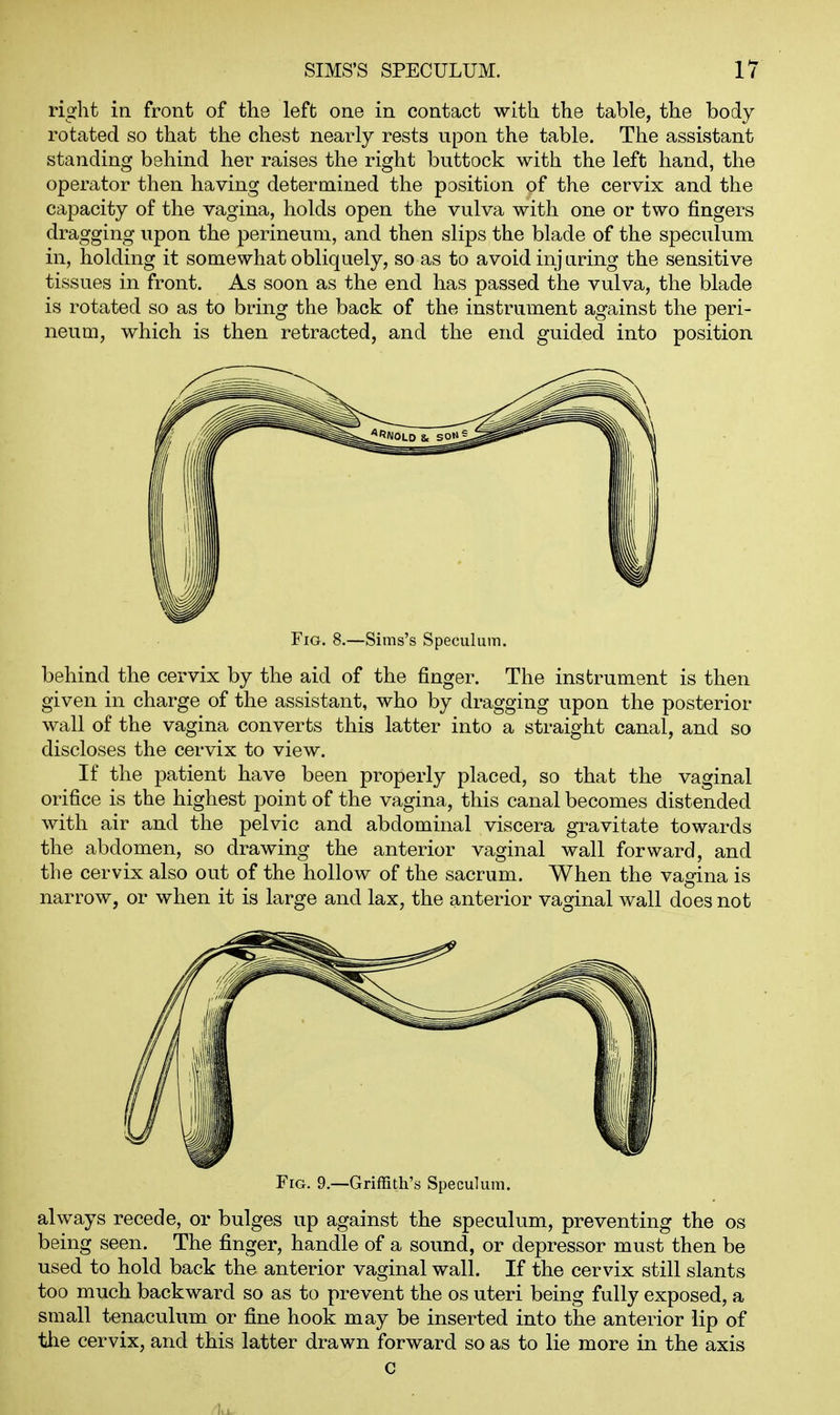 right in front of the left one in contact with the table, the body rotated so that the chest nearly rests upon the table. The assistant standing behind her raises the right buttock with the left hand, the operator then having determined the position of the cervix and the capacity of the vagina, holds open the vulva with one or two fingers dragging upon the perineum, and then slips the blade of the speculum in, holding it somewhat obliquely, so as to avoid inj tiring the sensitive tissues in front. As soon as the end has passed the vulva, the blade is rotated so as to bring the back of the instrument against the peri- neum, which is then retracted, and the end guided into position Fig. 8.—Sims's Speculum. behind the cervix by the aid of the finger. The instrument is then given in charge of the assistant, who by dragging upon the posterior wall of the vagina converts this latter into a straight canal, and so discloses the cervix to view. If the patient have been properly placed, so that the vaginal orifice is the highest point of the vagina, this canal becomes distended with air and the pelvic and abdominal viscera gravitate towards the abdomen, so drawing the anterior vaginal wall forward, and the cervix also out of the hollow of the sacrum. When the vagina is narrow, or when it is large and lax, the anterior vaginal wall does not Fig. 9.—Griffith's Speculum. always recede, or bulges up against the speculum, preventing the os being seen. The finger, handle of a sound, or depressor must then be used to hold back the anterior vaginal wall. If the cervix still slants too much backward so as to prevent the os uteri being fully exposed, a small tenaculum or fine hook may be inserted into the anterior lip of the cervix, and this latter drawn forward so as to lie more in the axis c