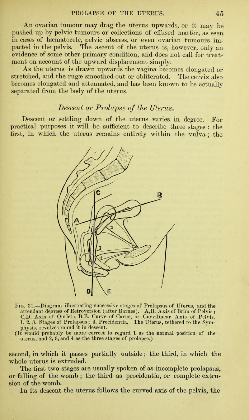 An ovarian tumour may drag the uterus upwards, or it may be puslied up by pelvic tumours or collections of effused matter, as seen in cases of hsematocele, pelvic abscess, or even ovarian tumours im- pacted in the pelvis. The ascent of the uterus is, however, only an evidence of some other primary condition, and does not call for treat- ment on account of the upward displacement simply. As the uterus is drawn upwards the vagina becomes elongated or stretched, and the rugae smoothed out or obliterated. The cervix also becomes elongated and attenuated, and has been known to be actually separated from the body of the uterus. Descent or Prolajpse of the Uterus. Descent or settling down of the uterus varies in degree. For practical purposes it will be sufficient to describe three stages : the first, in which the uterus remains entirely within the vulva; the Fig. 31.—Diagram illustrating successive stages of Prolapsus of Uterus, and the attendant degrees of Retroversion (after Barnes). A,B. Axis of Brim of Pelvis ; C,D. Axis cf Outlet ; B,E. Curve of Carus, or Curvilinear Axis of Pelvis. 1, 2, 3. Stages of Prolapsus ; 4. Procidentia. The Uterus, tethered to the Sym- physis, revolves round it in descent. (It would probably be more correct to regard 1 as the normal position of the uterus, and 2, 3, and 4 as the three stages of prolapse.) second, in which it passes partially outside; the third, in which the whole uterus is extruded. The first two stages are usually spoken of as incomplete prolapsus, or falling of the womb; the third as procidentia, or complete extru- sion of the womb. In its descent the uterus follows the curved axis of the pelvis, the