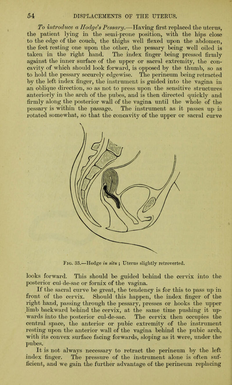 To introduce a Hodge^s Pessary.—Having first replaced the uterus, the patient lying in the semi-prone position, with the hips close to the edge of the couch, the thighs well flexed upon the abdomen, the feet resting one upon the other, the pessary being well oiled is taken in the right hand. The index finger being pressed firmly against the inner surface of the upper or sacral extremity, the con- cavity of which should look forward, is opposed by the thumb, so as to hold the pessary securely edgewise. The perineum being retracted by the left index finger, the instrument is guided into the vagina in an oblique direction, so as not to press upon the sensitive structures anteriorly in the arch of the pubes, and is then directed quickly and firmly along the posterior wall of the vagina until the whole of the pessary is within the passage. The instrument as it passes up is rotated somewhat, so that the concavity of the vipper or sacral curve Fig. 33.—Hodge in situ ; Uterus sliglitly retroverted. looks forward. This should be guided behind the cervix into the posterioi cvii de-sac or fornix of the vagina. If the sacral curve be great, the tendency is for this to pass up in front of the cervix. Should this happen, the index finger of the right hand, passing through the pessary, presses or hooks the upper limb backward behind the cervix, at the same time pushing it up- wards into the posterior cul-de-sac. The cervix then occupies the central space, the anterior or pubic extremity of the instrument resting upon the anterior wall of the vagina behind the pubic arch, with its convex surface facing forwards, sloping as it were, under the pubes. It is not always necessary to retract the perineum by the left index finger. The pressure of the instrument alone is often suf- ficient, and we gain the further advantage of the perineum replacing