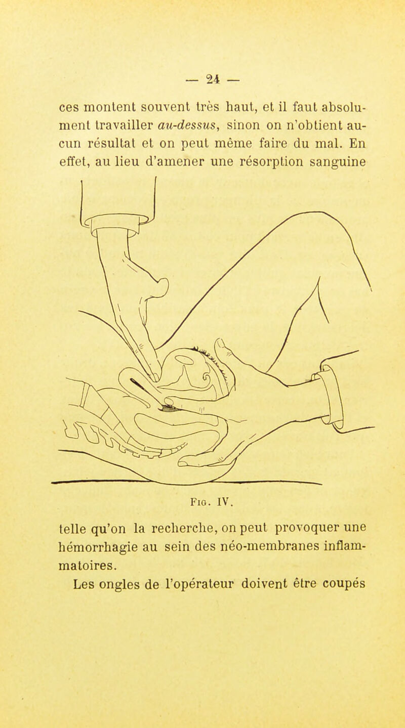 ces montent souvent très haut, et il faut absolu- ment travailler au-dessus, sinon on n'obtient au- cun résultat et on peut même faire du mal. En effet, au lieu d'amener une résorption sanguine Fio. IV. telle qu'on la recherche, on peut provoquer une hémorrhagie au sein des néo-membranes inflam- matoires. Les ongles de l'opérateur doivent être coupés