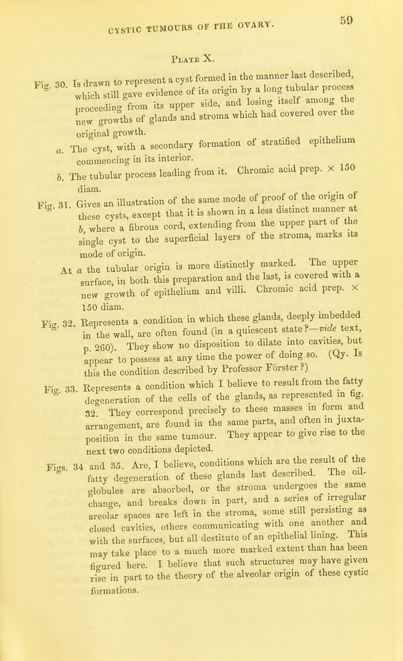 Plate X. K- 30 Is drawn to represent a cyst formed in the manner last described, g' whuTstill «ve evidence of its origin by a long tubular process proceed n.°from its upper side, and losing itself among he Tew !row°ths of glands and stroma which had covered over the original growth. a. The cyst, with a secondary formation of stratified epithelium commencing in its interior. b. The tubular process leading from it. Chromic acid prep. X 150 diam. . . Pi- 31 Gives an illustration of the same mode of proof of the or.gm of °* these cysts, except that it is shown in a less distinct manner at b where a fibrous cord, extending from the upper part of the single cyst to the superficial layers of the stroma, marks its mode of origin. At a the tubular origin is more distinctly marked. The upper surface in both this preparation and the last, is covered with a new growth of epithelium and villi. Chromic add prep. X 150 diam. Fiff 32. Kepresents a condition in which these glands, deeply imbedded in the wall, are often found (in a quiescent state ?-vide text, p 960) They show no disposition to dilate into cavities, but appear'to possess at any time the power of doing so. (Qy. Is this the condition described by Professor Forster?) Fia 33. Represents a condition which I believe to result from the fatty defeneration of the cells of the glands, as represented in fig 32° They correspond precisely to these masses in form and arrangement, are found in the same parts, and often m juxta- position in the same tumour. They appear to give r.se to the next two conditions depicted. Fi«s 34 and 35. Are, I believe, conditions which are the result of the ° ' fatty defeneration of these glands last described. The ml- olobules are absorbed, or the stroma undergoes the same change, and breaks down in part, and a series of irregular areofar spaces are left in the stroma, some still persisting as closed cavities, others communicating with one another and with the surfaces, but all destitute of an epithelial lining. This may take place to a much more marked extent than has been figured here. I believe that such structures may have given rise in part to the theory of the alveolar origin of these cystic formations.