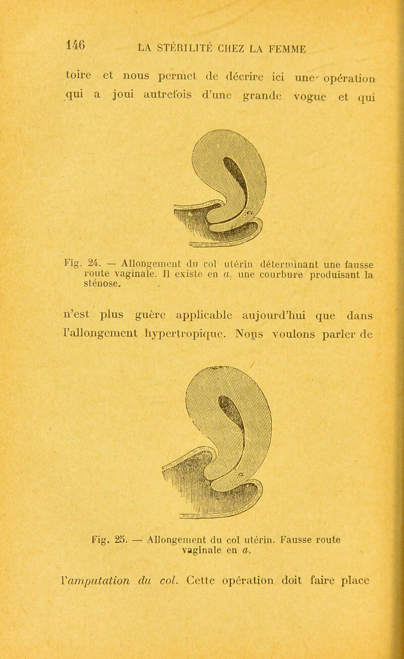 toire et nous peraiel de décrire ici une- opération qui a joui autrefois d'une grande vogue et qui Fig. 24. — Allongement du col utérin déterminant une fausse route vaginale. Il existe en a. une courbure produisant la sténose. n'est plus guère applicable aujourd'hui que dans l'allongement hyper tropique. Nous voulons parler de Fig. 25. — Allongement du col utérin. Fausse route vaginale en a. Y amputation du col. Celle opération doit faire place