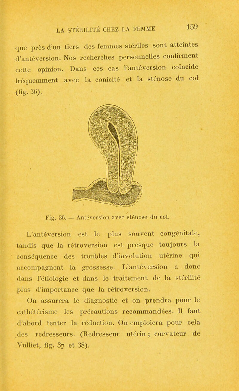 que près d'un tiers des femmes stériles sont atteintes d'antéversion. Nos recherches personnelles confirment cette opinion. Dans ces cas l'antéversion coïncide fréquemment avec la conicité et la sténose du col (fig. 36). Fig. 36. — Antéversion avec sténose du col. L'antéversion est le plus souvent congénitale, landis que la rétroversion est presque toujours la conséquence des troubles d'involution utérine qui accompagnent la grossesse. L'antéversion a donc dans l'étiologie et dans le traitement de la stérilité plus d'importance que la rétroversion. On assurera le diagnostic et on prendra pour le caihélérisme les précautions recommandées. Il faut d'abord tenter la réduction. On emploiera pour cela des redresseurs. (Redresseur utérin ; curvateur de Vulliet, fig. 3? et 38).