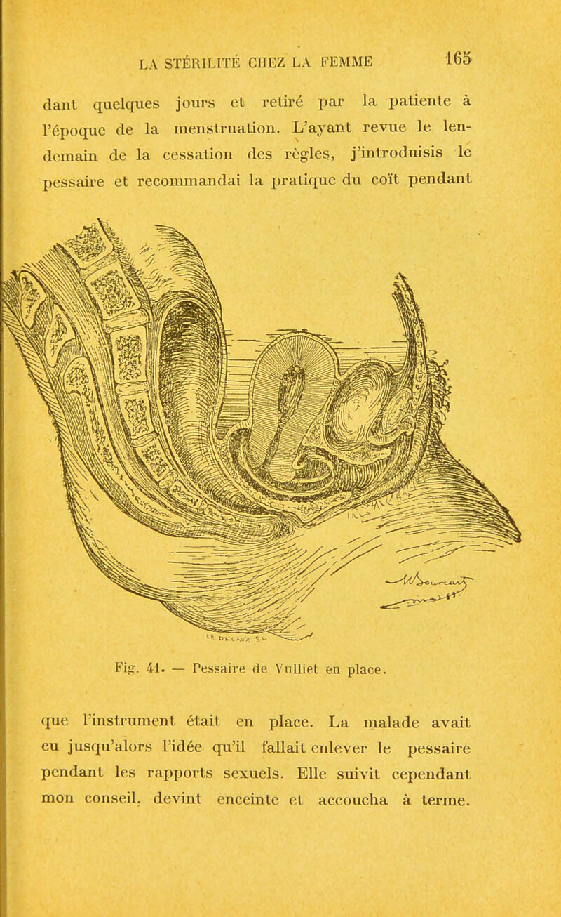 dant. quelques jours et retiré par la patiente à l'époque de la menstruation. L'ayant revue le len- demain de la cessation des règles, j'introduisis le pessaire et recommandai la pratique du coït pendant Fig. 41. — Pessaire de Vulliet en place. que l'instrument était en place. La malade avait eu jusqu'alors l'idée qu'il fallait enlever le pessaire pendant les rapports sexuels. Elle suivit cependant mon conseil, devint enceinte et accoucha à terme.