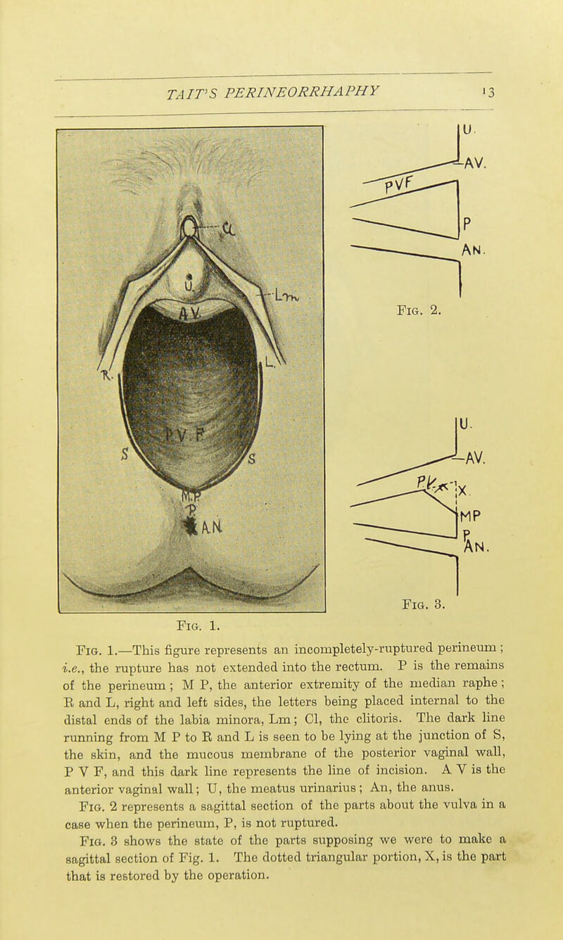 Fig. 1. Fig. 1.—This figure represents an incompletely-ruptured perineum ; i.e., the rupture has not extended into the rectum. P is the remains of the perineum ; M P, the anterior extremity of the median raphe; E and L, right and left sides, the letters being placed internal to the distal ends of the labia minora, Lm; CI, the clitoris. The dark line running from M P to R and L is seen to be lying at the junction of S, the skin, and the mucous membrane of the posterior vaginal wall, P V F, and this dark line represents the line of incision. A V is the anterior vaginal wall; U, the meatus urinarius; An, the anus. Fig. 2 represents a sagittal section of the parts about the vulva in a case when the perineum, P, is not ruptured. Fig. 3 shows the state of the parts supposing we were to make a sagittal section of Fig. 1. The dotted triangular portion, X, is the part that is restored by the operation.