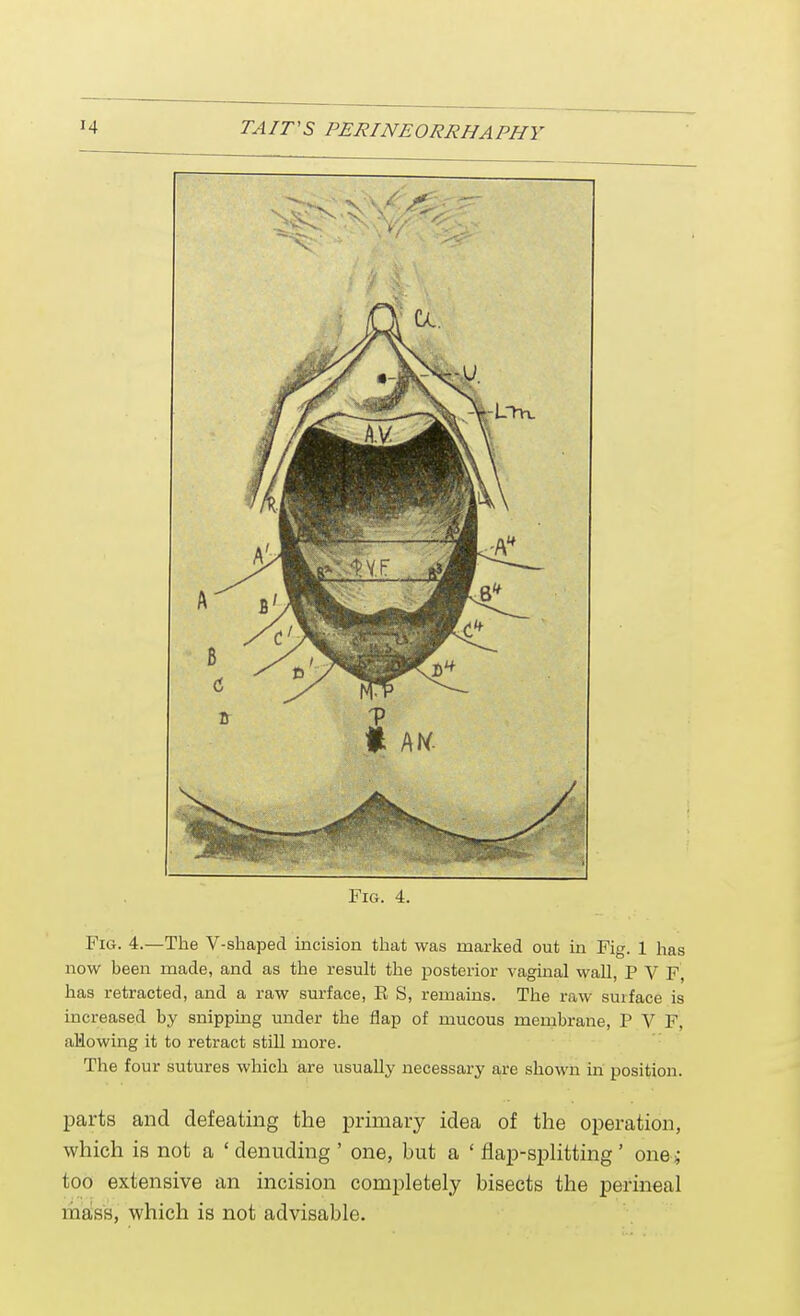 Fig. 4. Fig. 4.—The V-shaped incision that was marked out in Fig. 1 has now been made, and as the result the posterior vaginal wall, P V F, has retracted, and a raw surface, E S, remains. The raw surface is increased by snipping under the flap of mucous membrane, P V F, allowing it to retract still more. The four sutures which are usually necessary are shown in position. parts and defeating the primary idea of the operation, which is not a ' denuding ' one, but a ' flap-splitting ' one „• too extensive an incision completely bisects the perineal mass, which is not advisable.