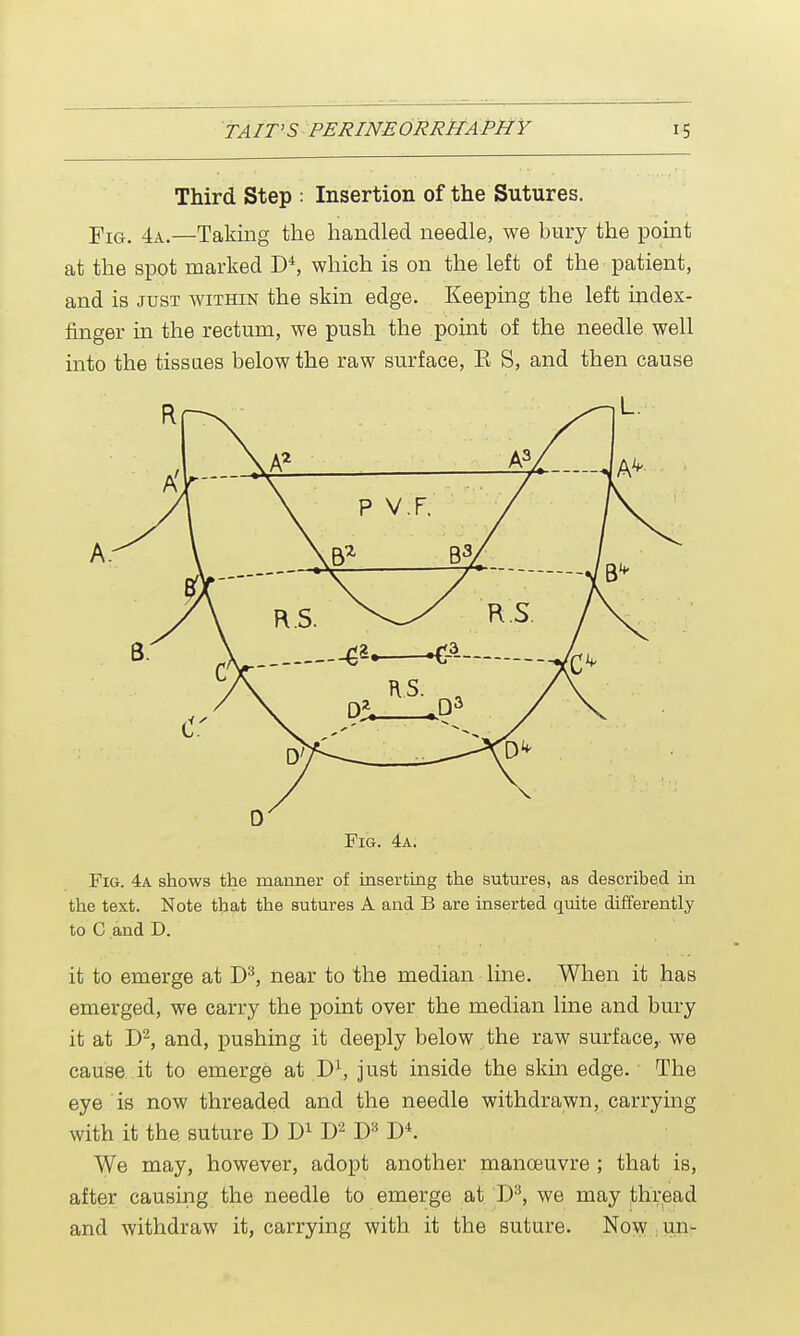 Third Step : Insertion of the Sutures. Fig. 4a.—Taking the handled needle, we bury the point at the spot marked D4, which is on the left of the patient, and is just within the skin edge. Keeping the left index- finger in the rectum, we push the point of the needle well into the tissues below the raw surface, E S, and then cause Fig. 4a. Fig. 4a shows the manner of inserting the sutures, as described in the text. Note that the sutures A and B are inserted quite differently to C and D. it to emerge at D3, near to the median line. When it has emerged, we carry the point over the median line and bury it at D2, and, pushing it deeply below the raw surface, we cause it to emerge at D1, just inside the skin edge. The eye is now threaded and the needle withdrawn, carrying with it the suture D D1 D2 D3 V>\ We may, however, adopt another manoeuvre ; that is, after causing the needle to emerge at D3, we may thread and withdraw it, carrying with it the suture. Now Un~