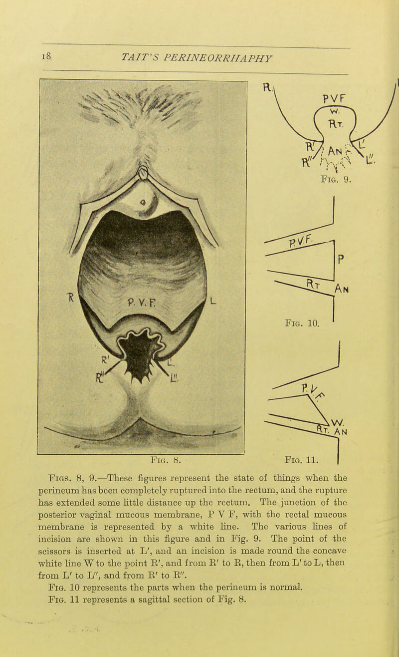 Fig. 8. Fig. 11. Figs. 8, 9.—These figures represent the state of things when the perineum has been completely ruptured into the rectum, and the rupture has extended some little distance up the rectum. The junction of the posterior vaginal mucous membrane, P V F, with the rectal mucous membrane is represented by a white line. The various lines of incision are shown in this figure and in Fig. 9. The point of the scissors is inserted at L', and an incision is made round the concave white line W to the point E', and from E' to E, then from L' to L, then from L' to L, and from E' to E. Fig. 10 represents the parts when the perineum is normal. Fig. 11 represents a sagittal section of Fig. 8.