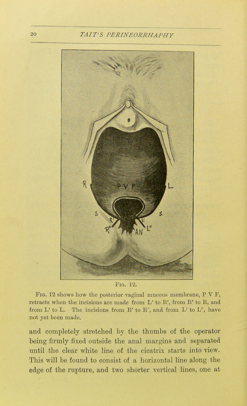 Fig. 12. Fig. 12 shows how the posterior vaginal mucous membrane, P V F, retracts when the incisions are made from L' to R', from R' to R, and from L' to L. The incisions from R' to R, and from L' to L, have not yet been made. and completely stretched by the thumbs of the operator being firmly fixed outside the anal margins and separated until the clear white line of the cicatrix starts into view. This will be found to consist of a horizontal line along the edge of the rupture, and two shorter vertical lines, one at