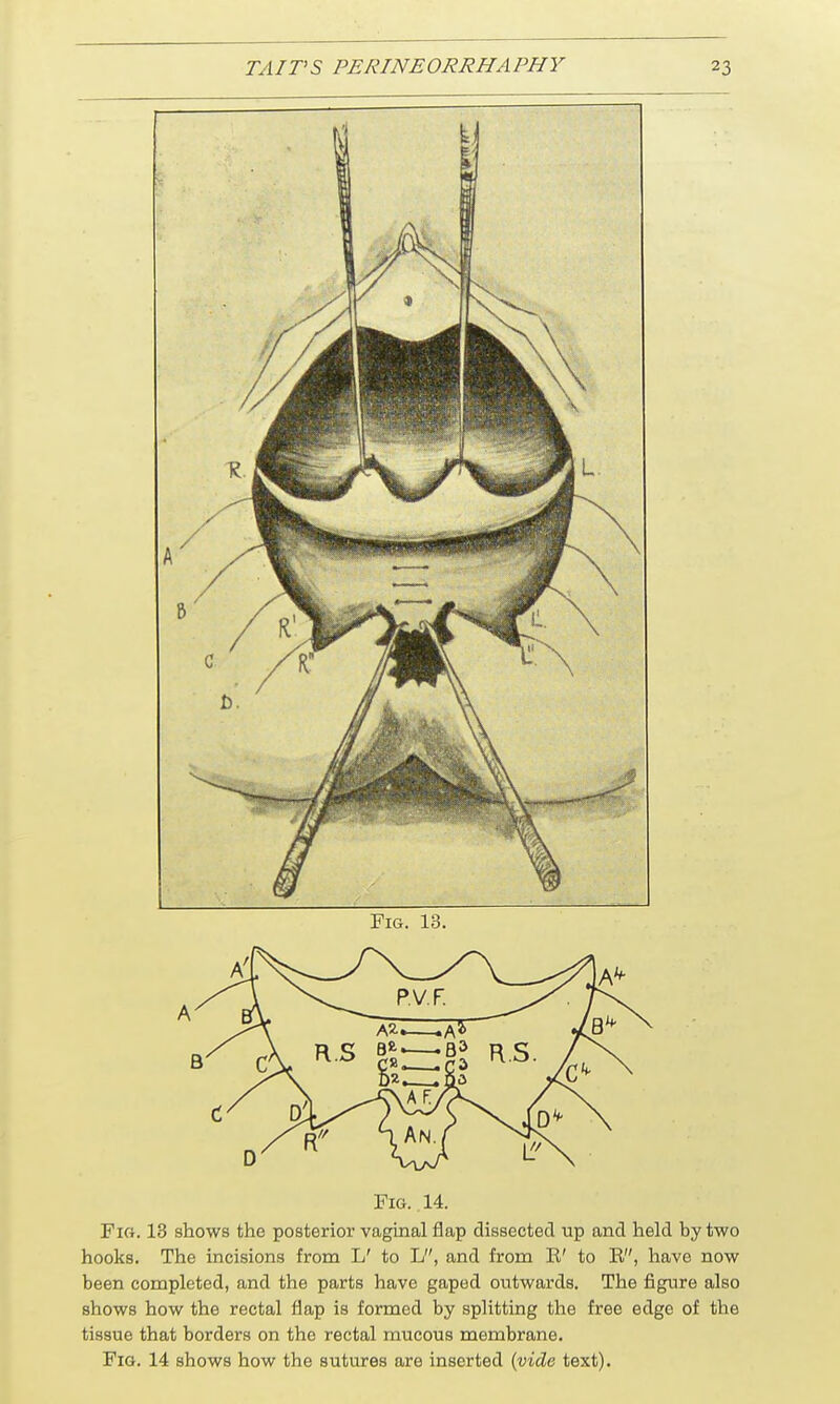 Fig.. 14. Fig. 13 shows the posterior vaginal flap dissected up and held hy two hooks. The incisions from L' to L, and from E' to E, have now been completed, and the parts have gaped outwards. The figure also shows how the rectal flap is formed by splitting the free edge of the tissue that borders on the rectal mucous membrane. Fig. 14 shows how the sutures are inserted {vide text).